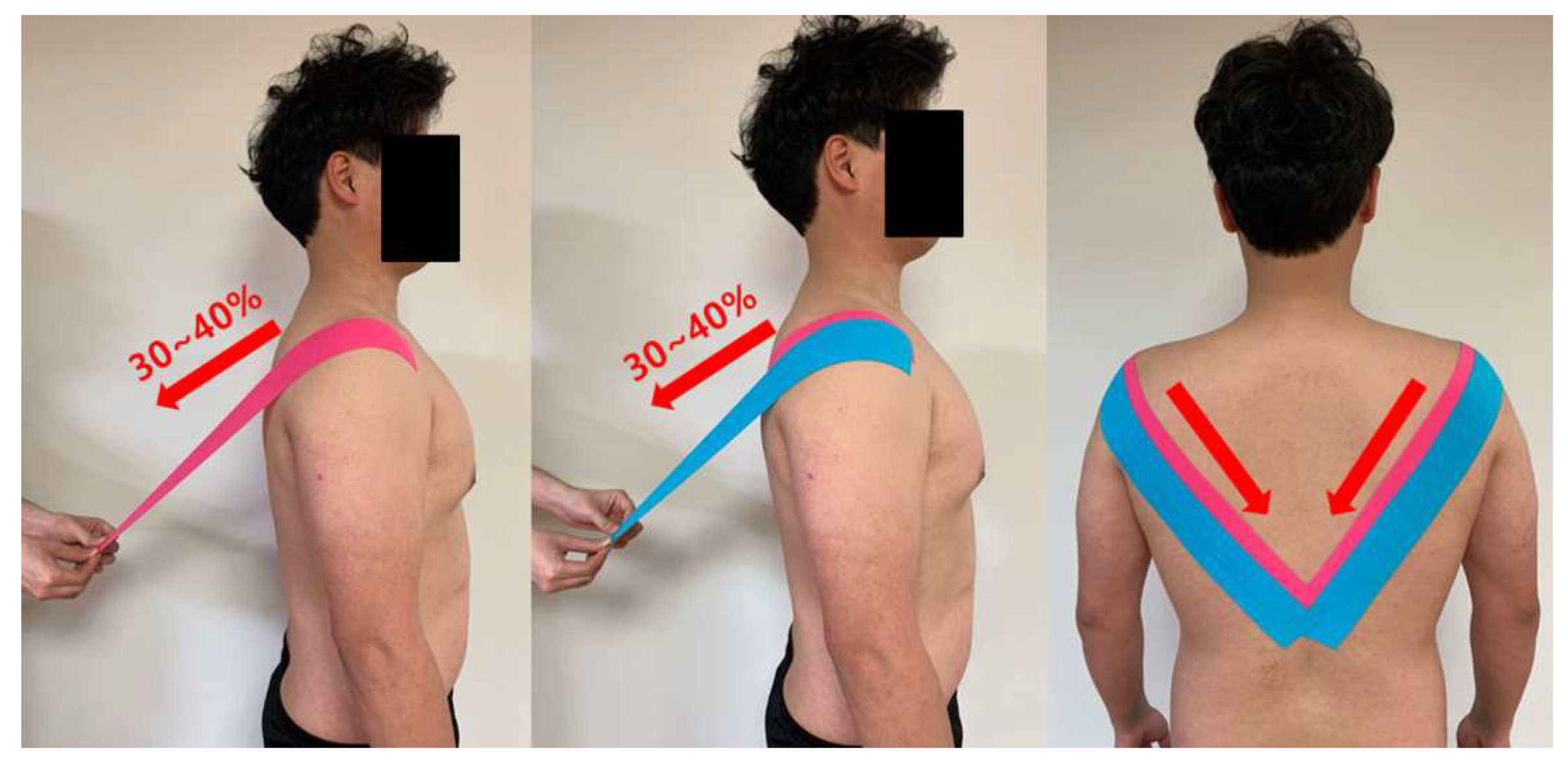 Life Free FullText Effects of Kinesiology Taping on Shoulder