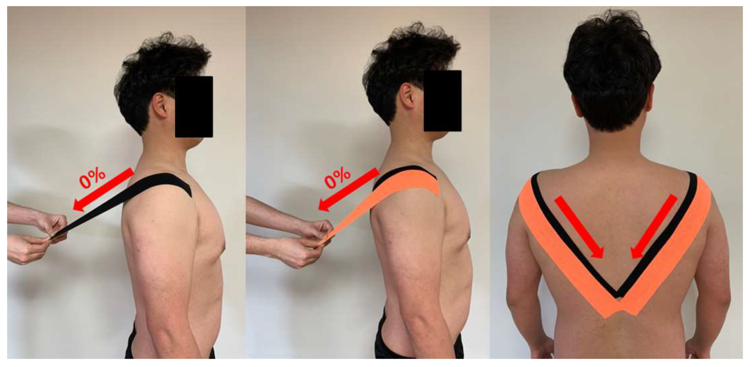 Kt Tape Upper Back Shoulder Blade | vlr.eng.br