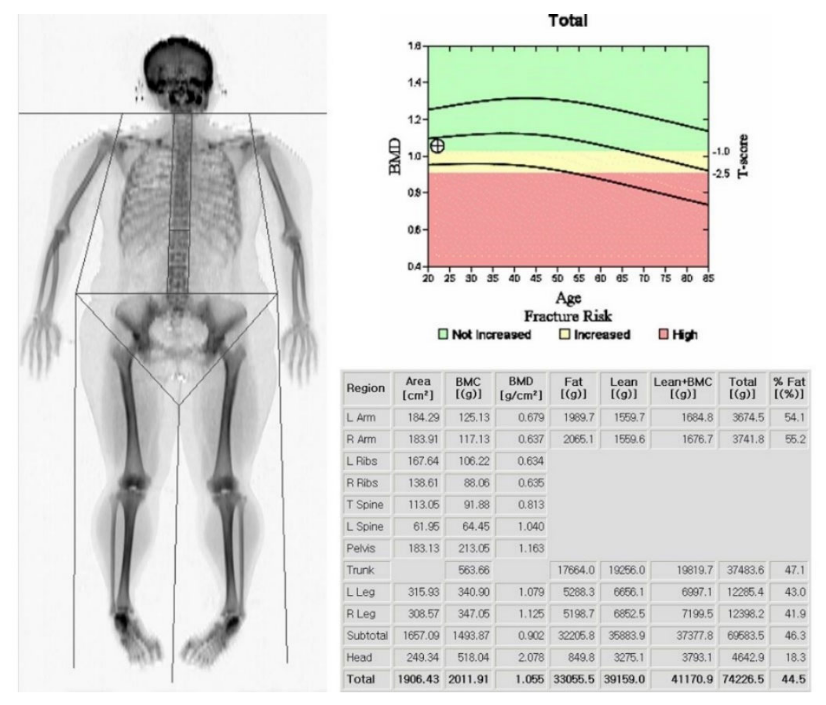 Life Free Full Text Radiologic Definition Of Sarcopenia In Chronic Liver Disease Html