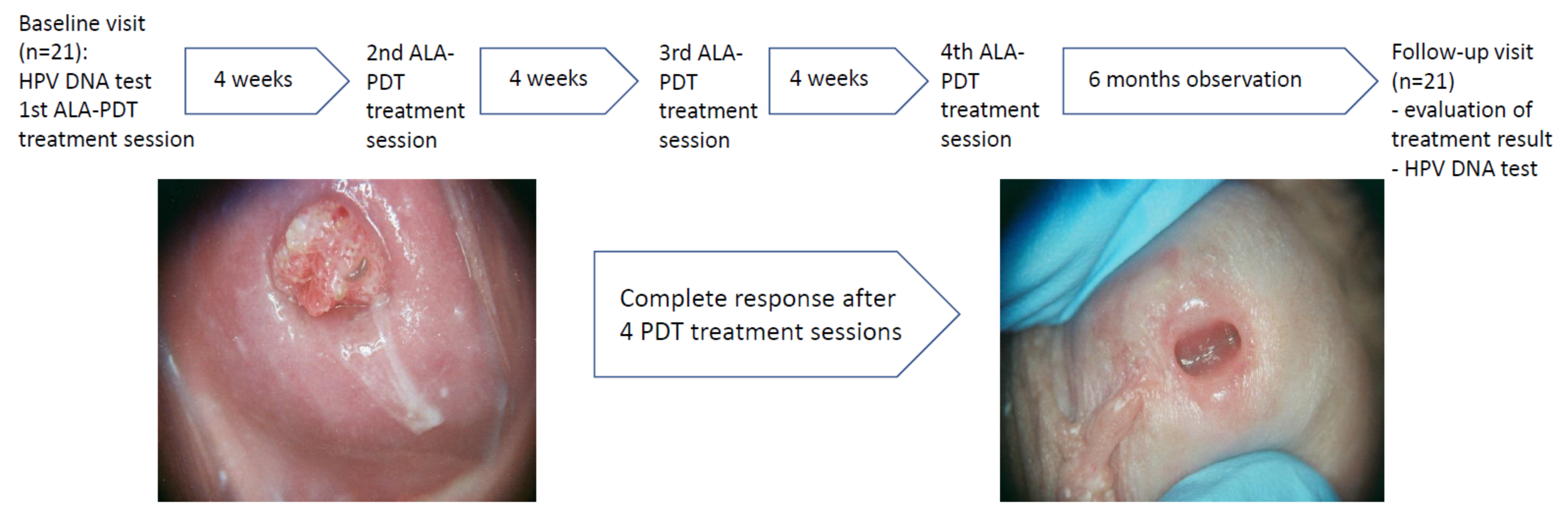 Hpv treatment before and after. Noi tratamente sistemice în infecţia cu HPV