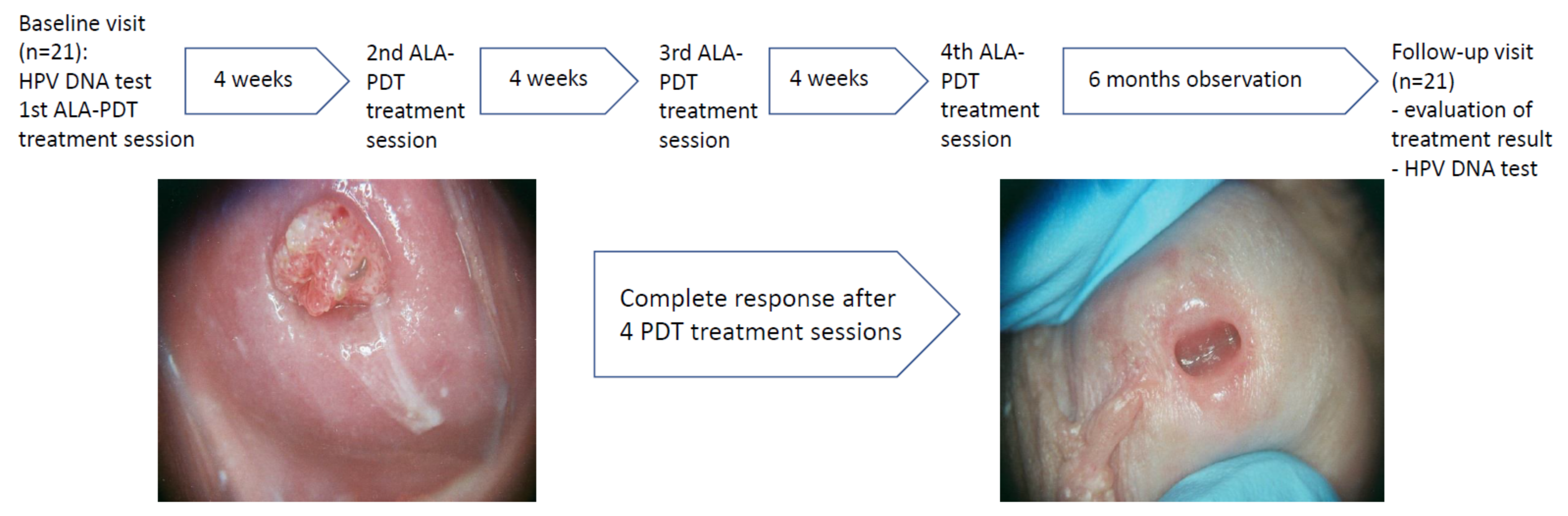 hpv treatment before and after
