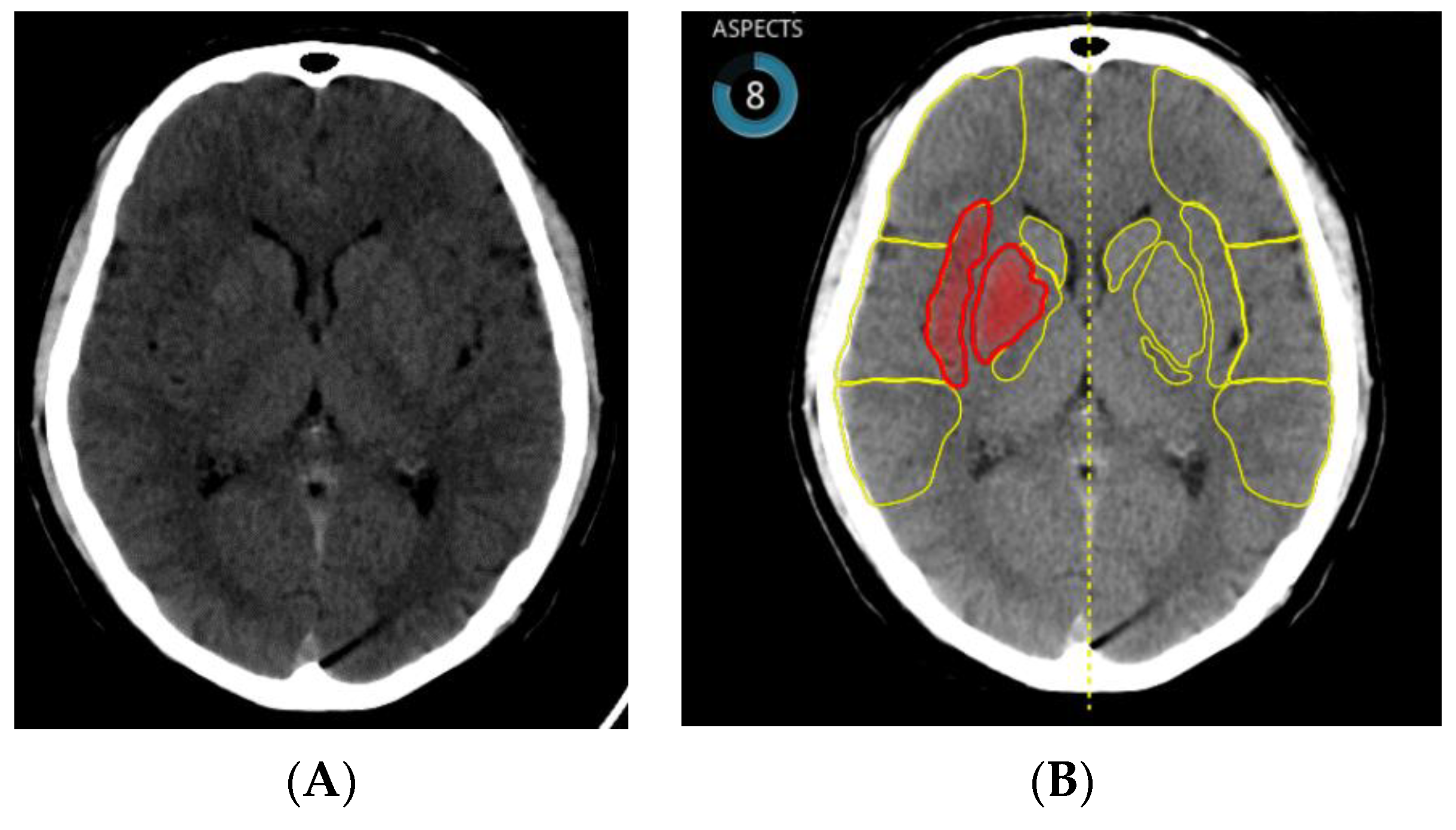 Study promises novel blood test to detect minor, hidden strokes