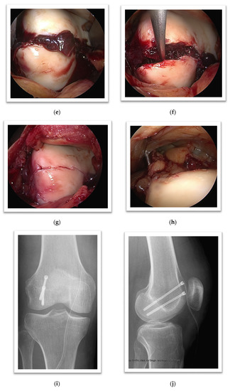 krónikus arthrosis a lábak ízületeinek reumájának kezelése