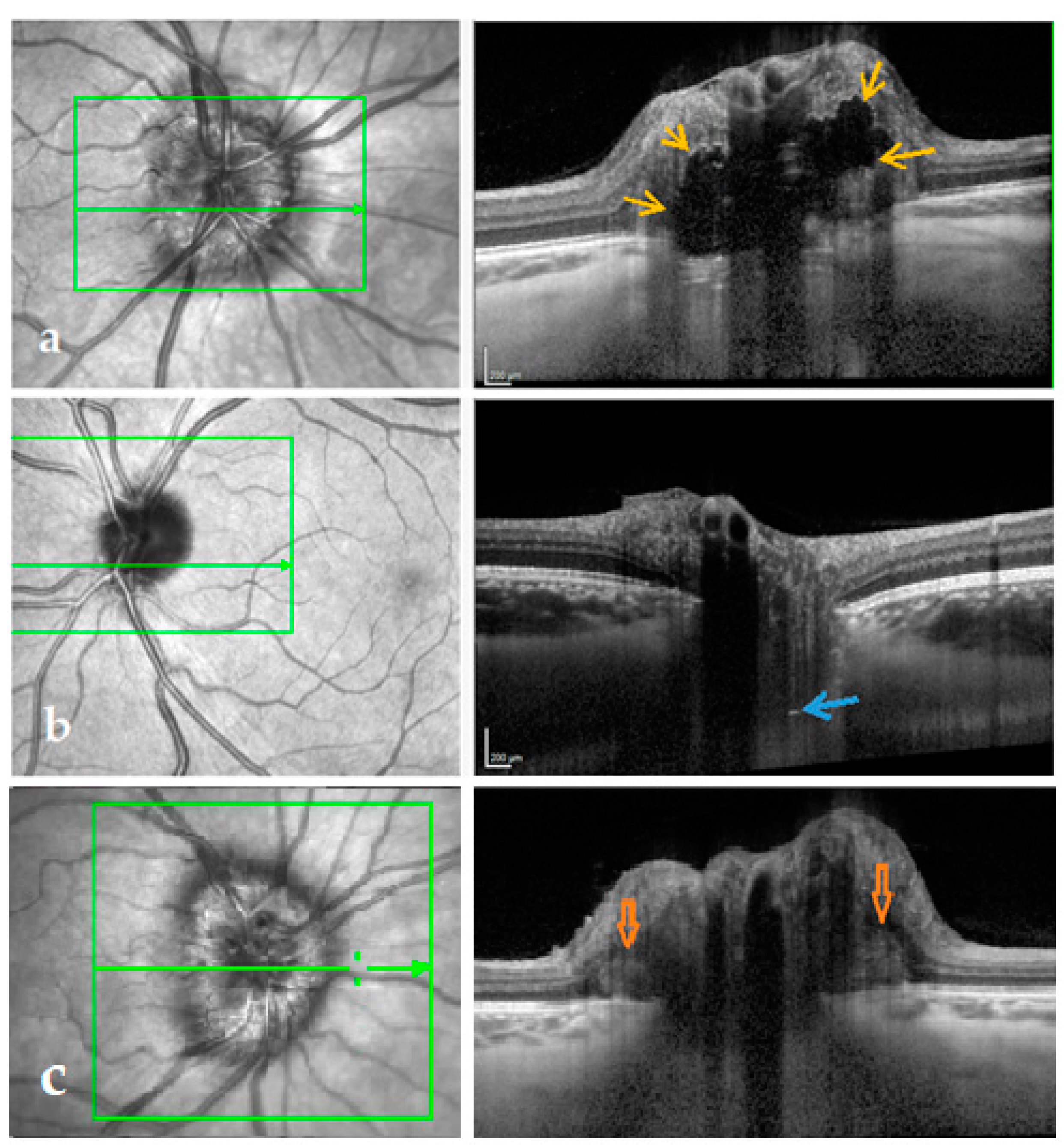 Life | Free Full-Text | OCT Based Interpretation of the Optic Nerve