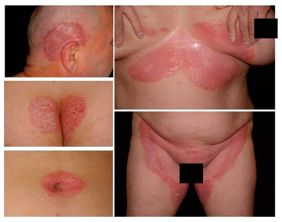 Psoriasis pubis terület