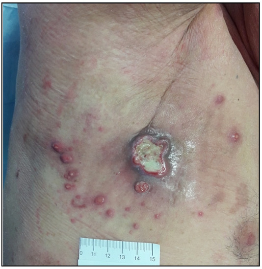 Lymphoma-Hodgkin lymphoma-Allopathic and Homeopathic Treatment | Homeopathic | Best Homeopathic Doctor in Pakistan | Dr Qaisar Ahmed MD, DHMS