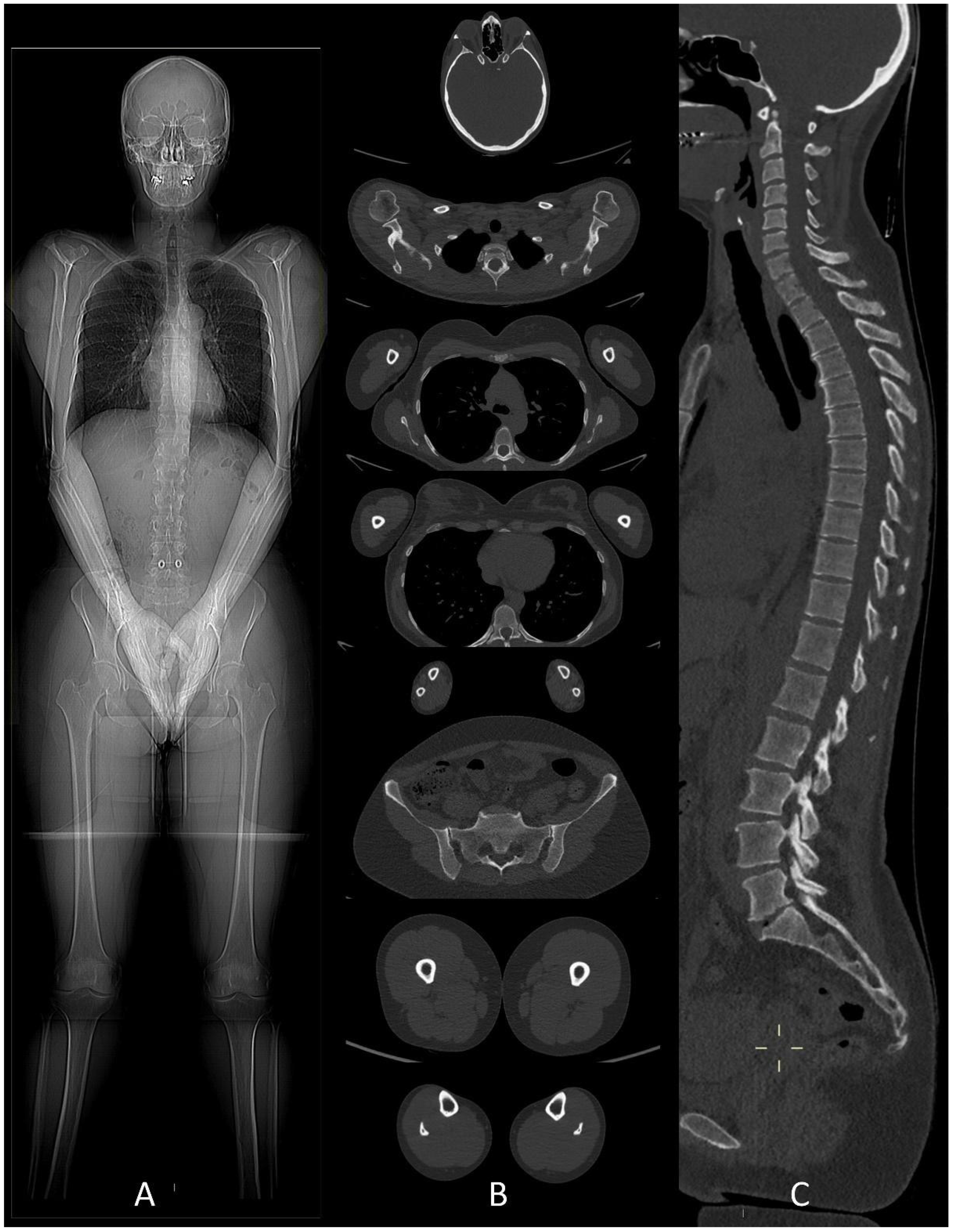 Life | Free Full-Text | Whole-Body Low-Dose CT in Multiple Myeloma: in Observing, and Interpreting the Imaging Findings