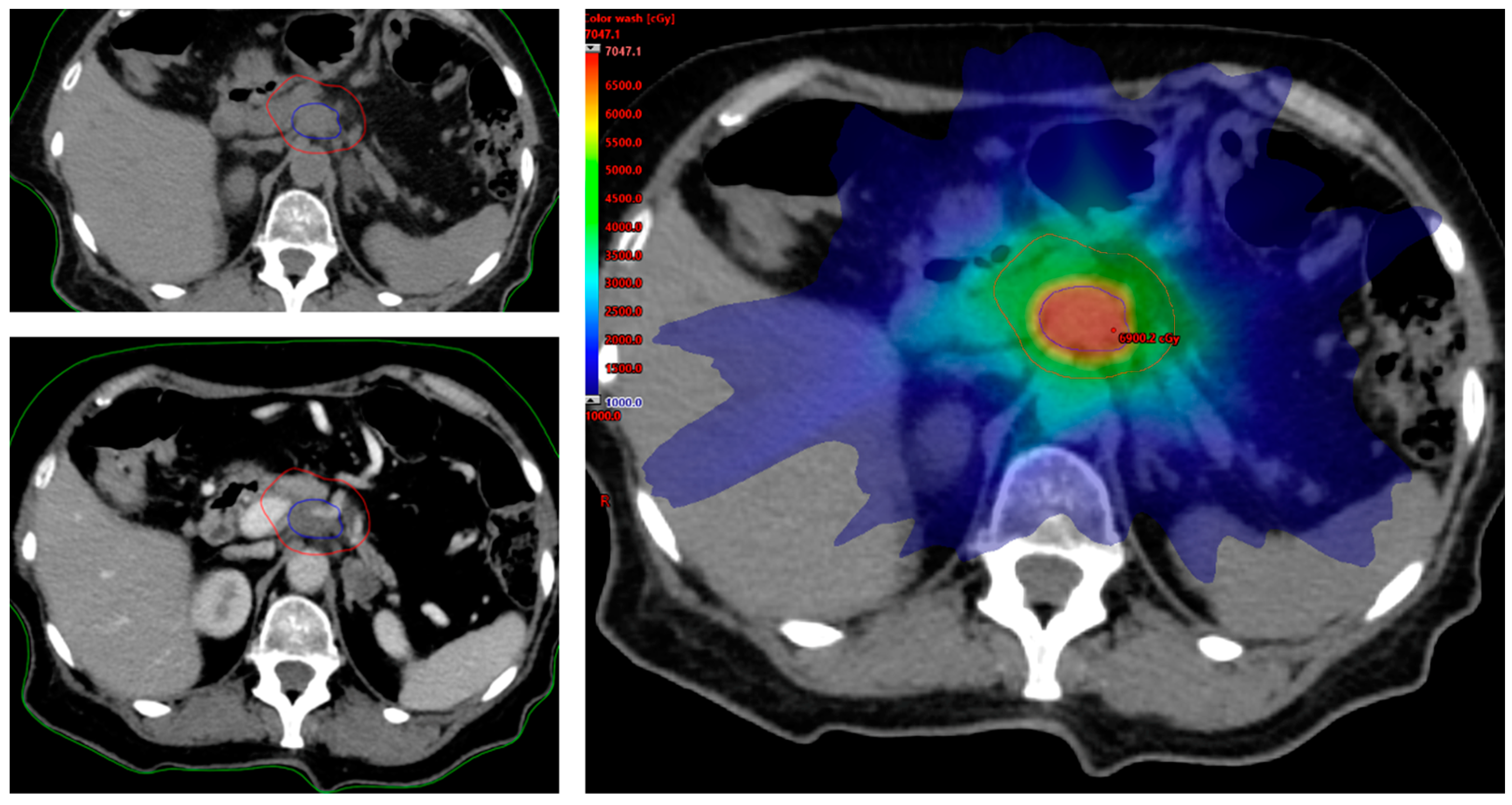 Life | Free Full-Text | Ablative Radiotherapy (Art) For Locally Advanced Pancreatic  Cancer (Lapc): Toward A New Paradigm? | Html