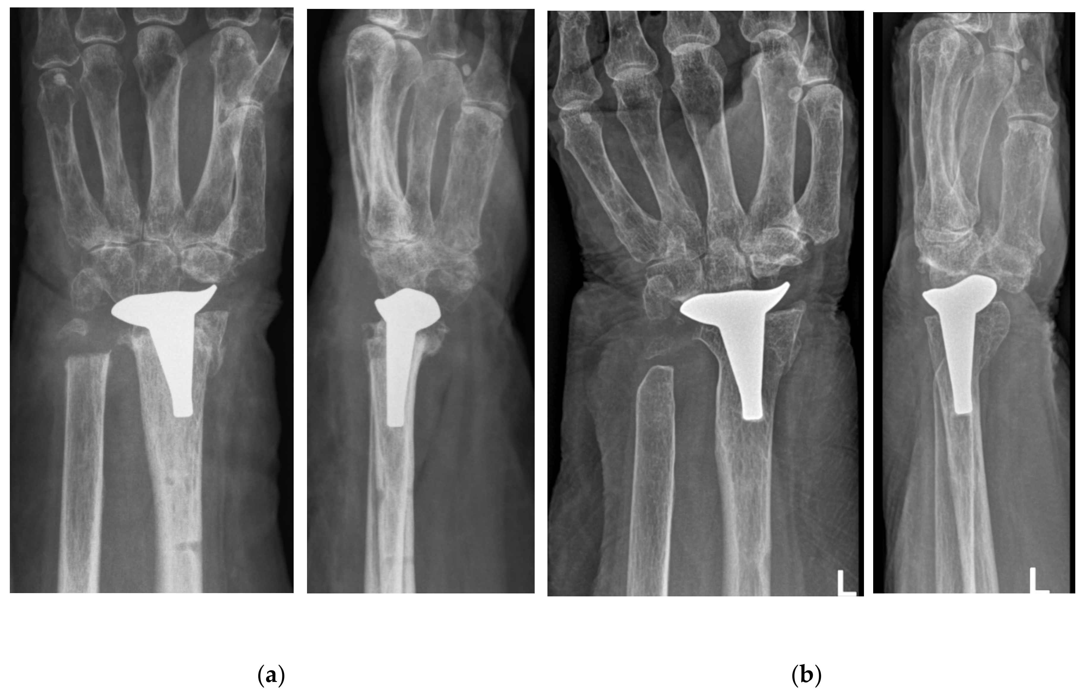 健康・医学 Distal Radius Fractures and Carpal Distal Radius Fracture: Diagnosis, Treatment, Recovery