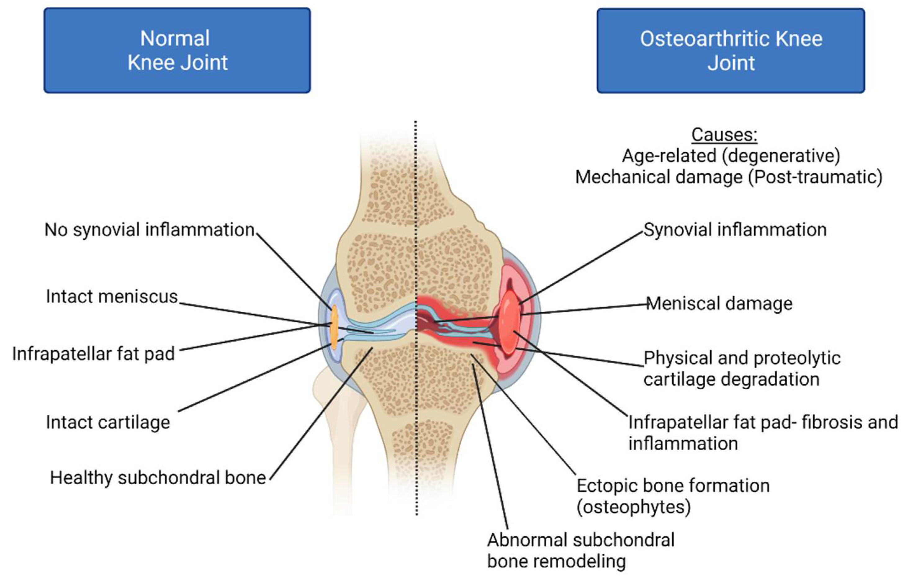 osteoarthritis 2 3 fok