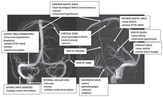 The larger superficial cerebral veins, including those draining the