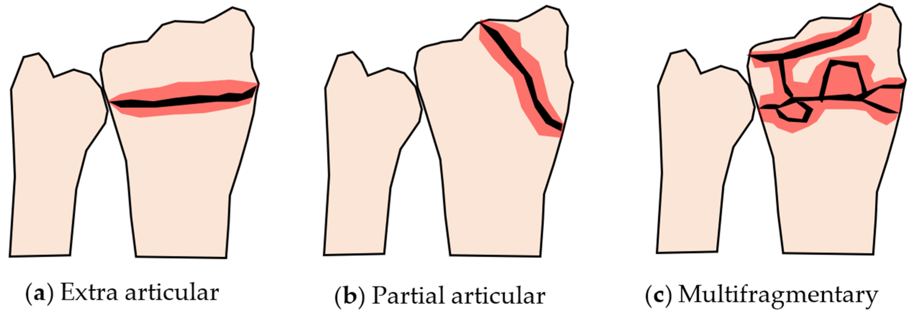 Life Free FullText Variations in Strain Distribution at Distal