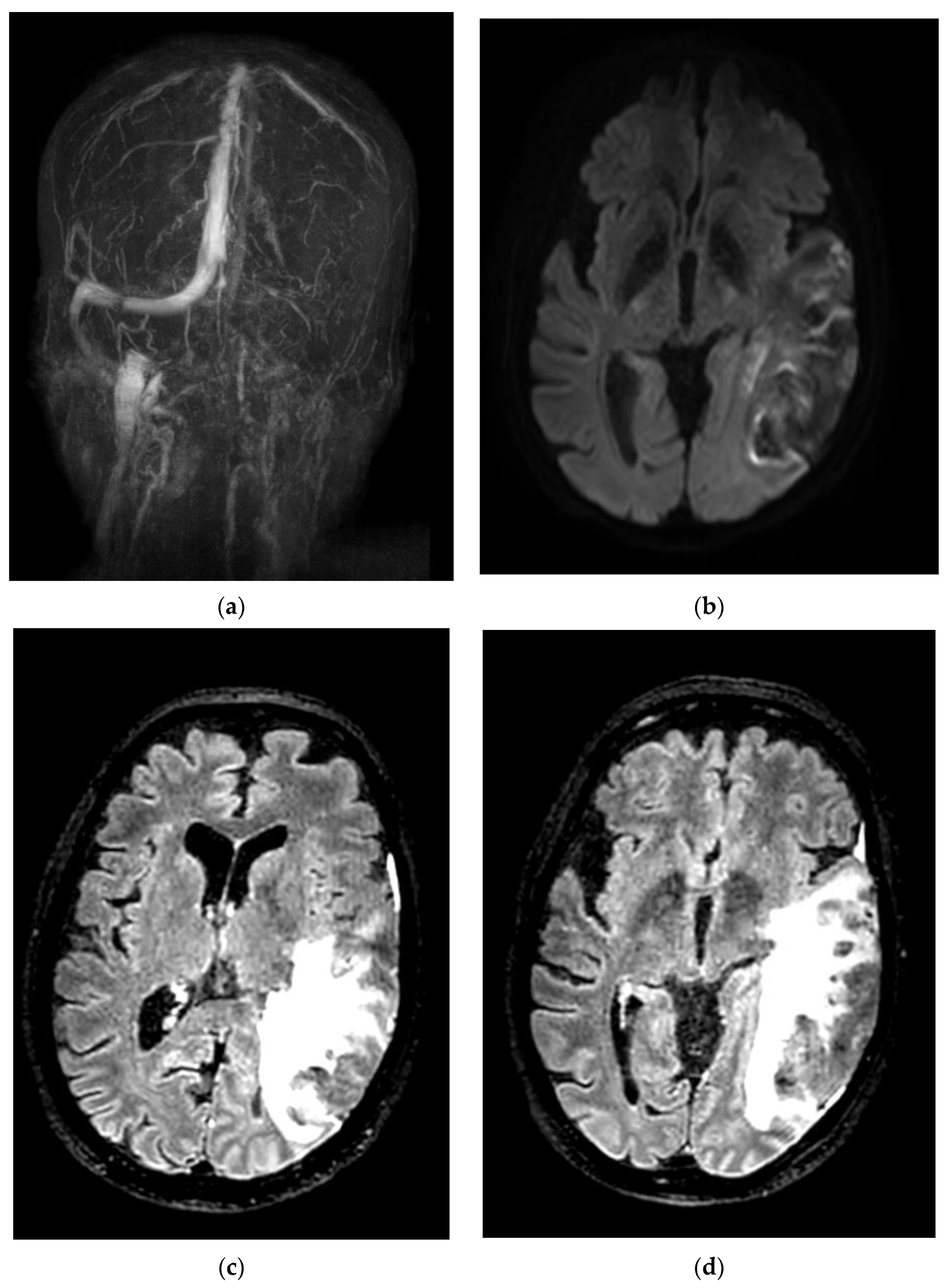 cortical vein thrombosis