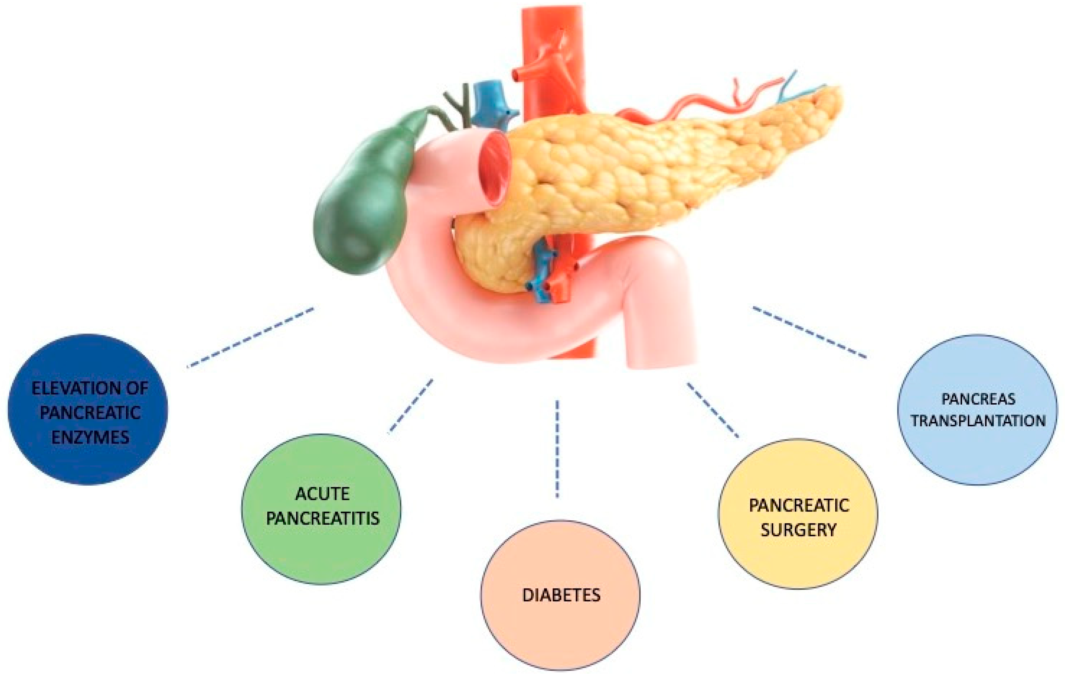 Se puede repetir una pancreatitis