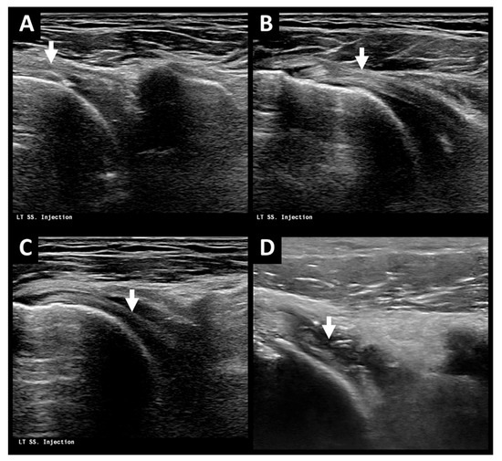 Life Free FullText Management of Patients with Adhesive Capsulitis