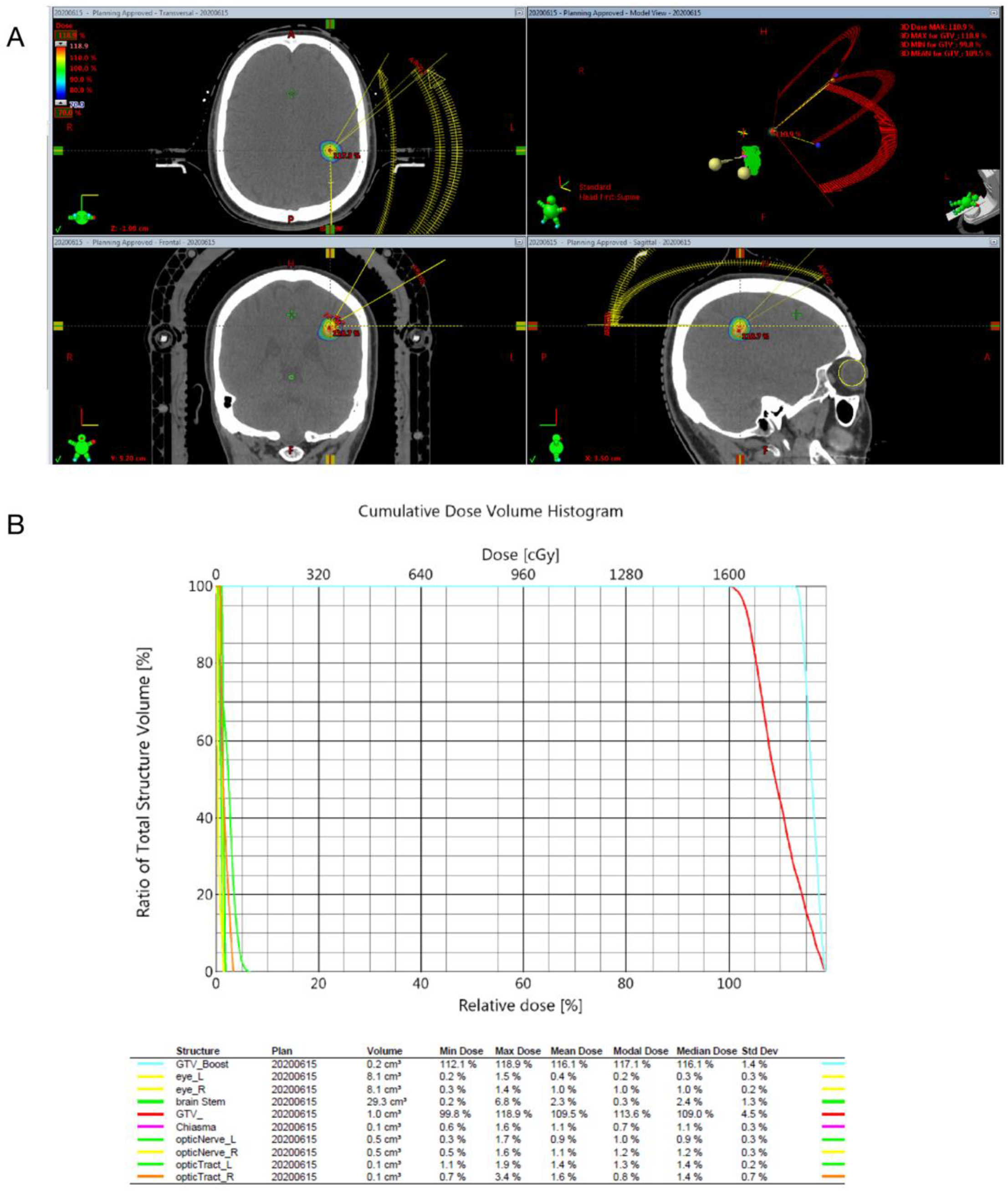 Prognostic Factors Analysis for Intracranial Cavernous