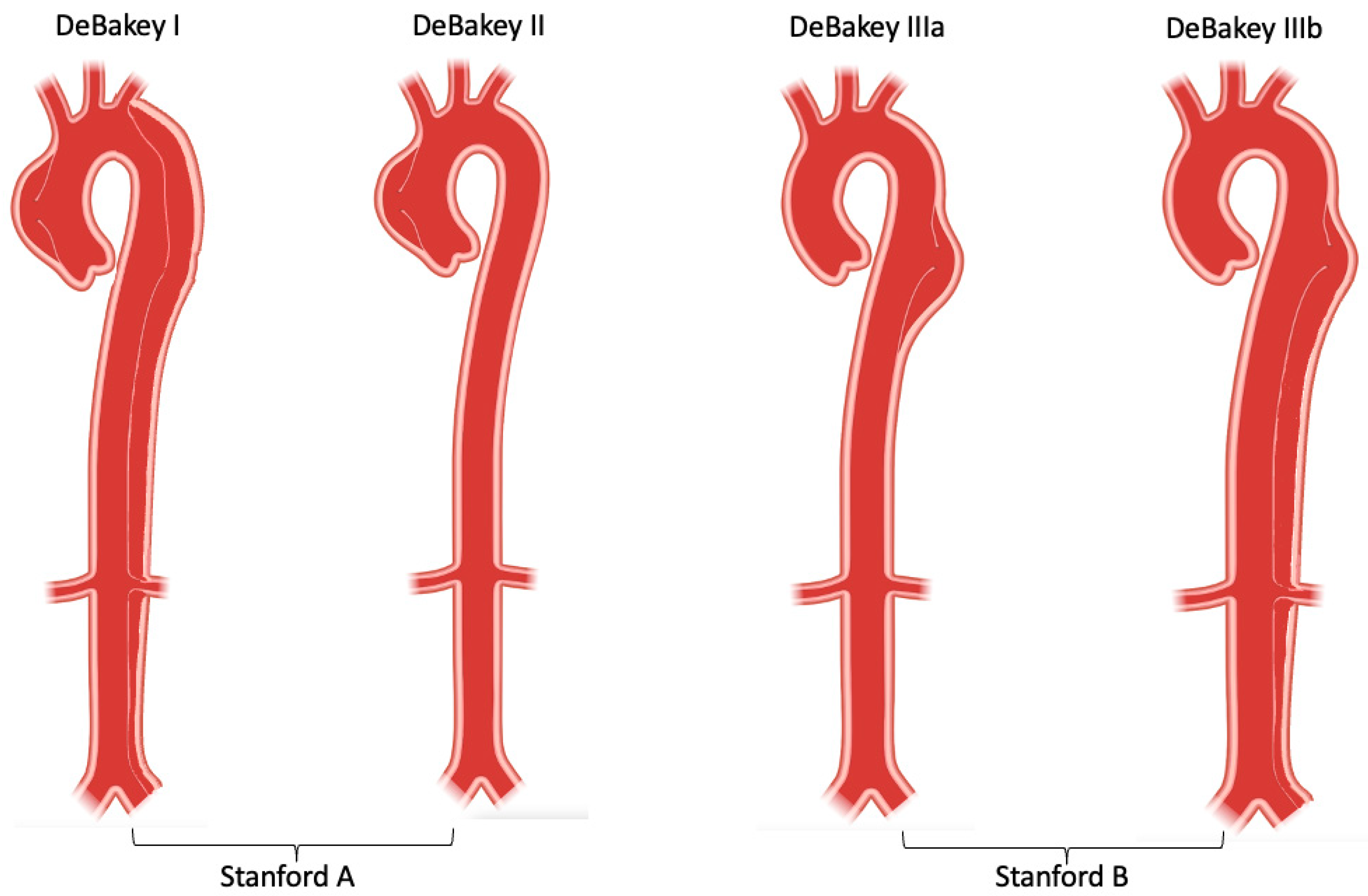 Life Free FullText Current Understanding of Aortic Dissection