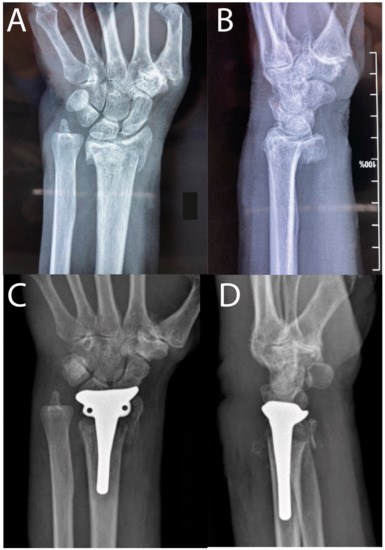 Surgical Treatment for 4 Types of Wrist Fractures