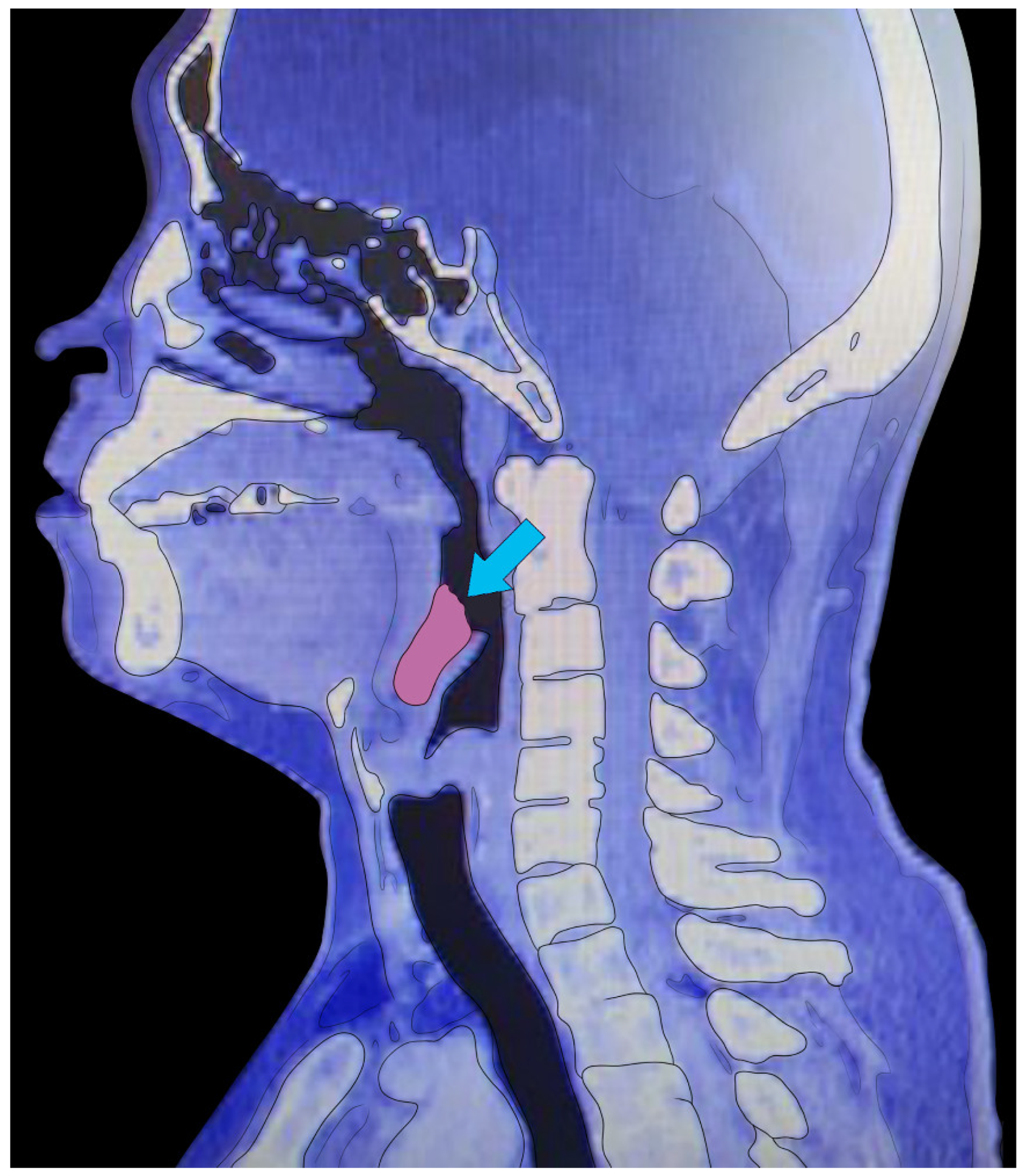 Tonsil Trouble? Identify All Your Tonsils Now! - tmrbur0