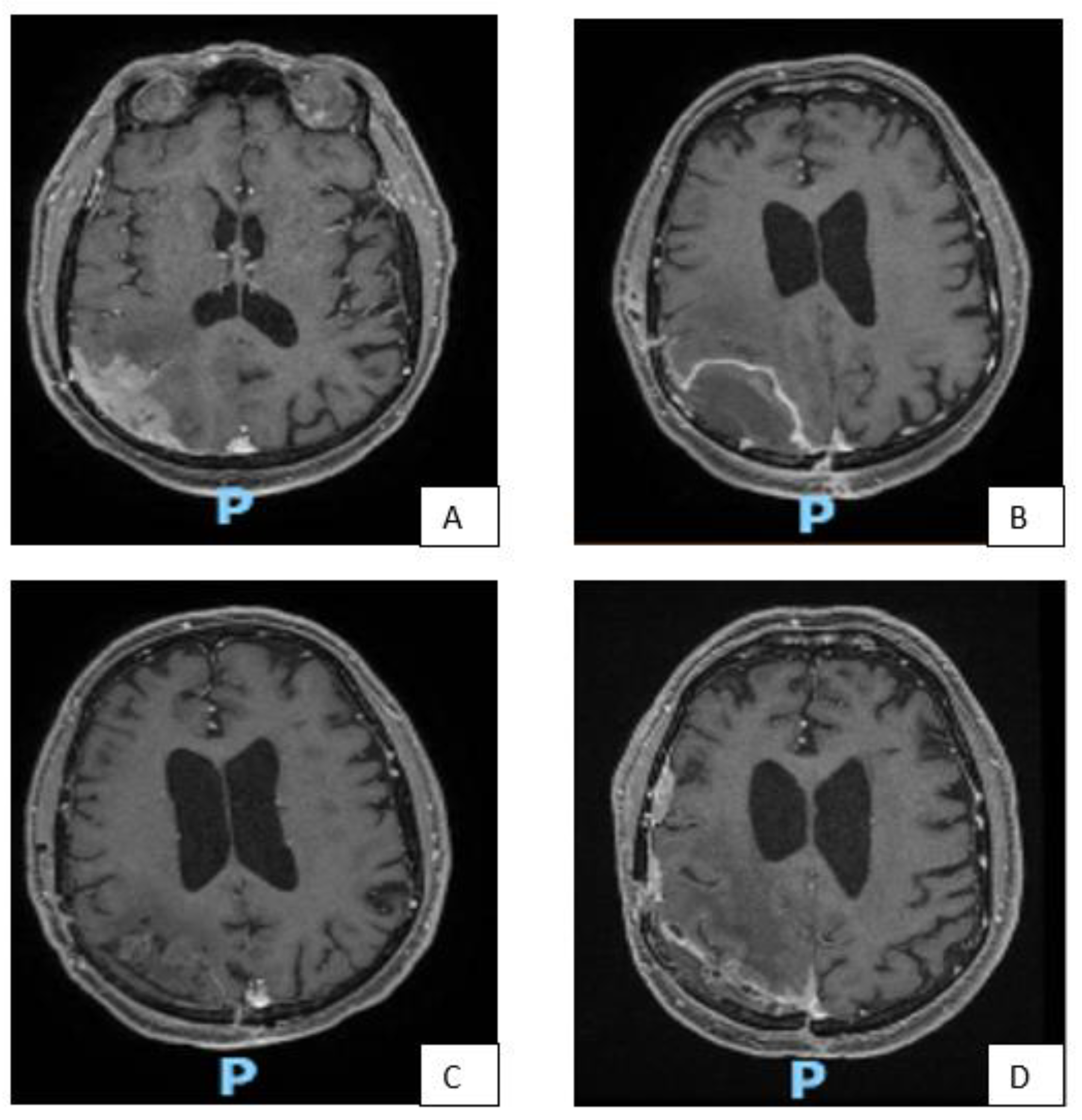 Life Free FullText Post Surgical Management of WHO Grade II Meningiomas Our Experience
