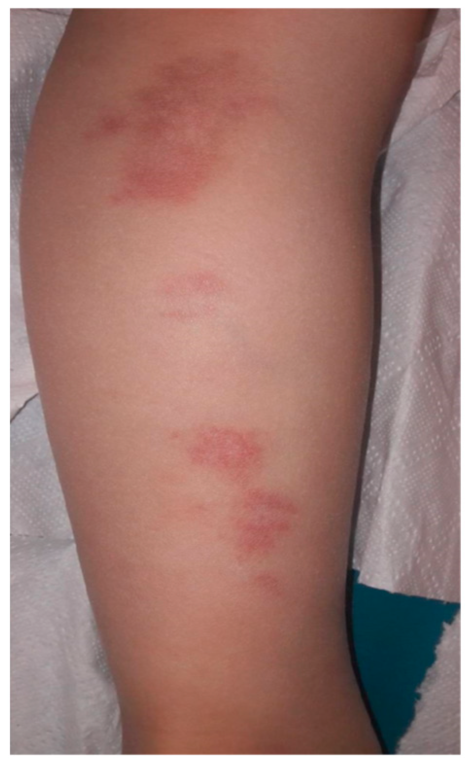 6 Year Old Lyme Disease: Symptoms & Treatment