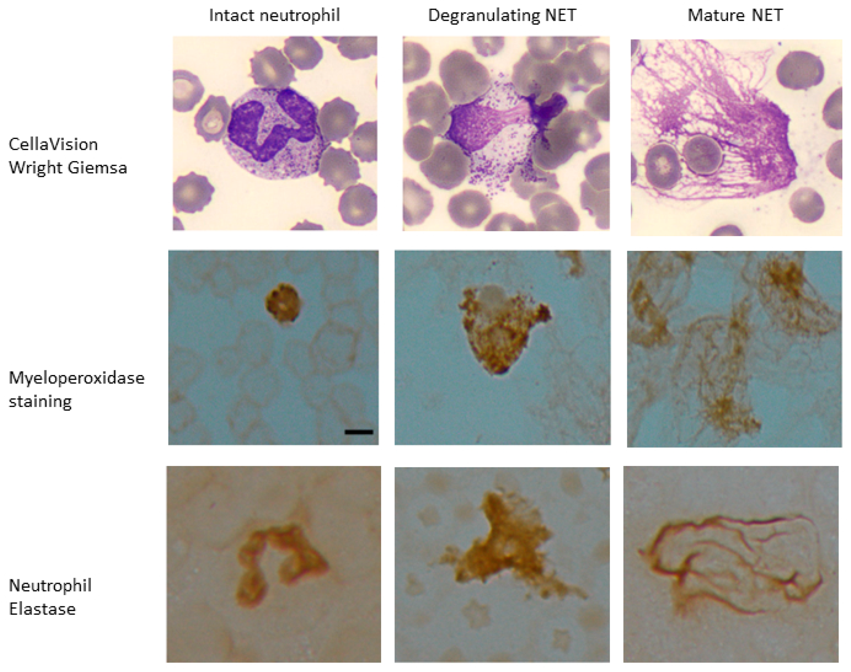 Life | Free Full-Text | Identifying Neutrophil Extracellular Traps (NETs)  in Blood Samples Using Peripheral Smear Autoanalyzers