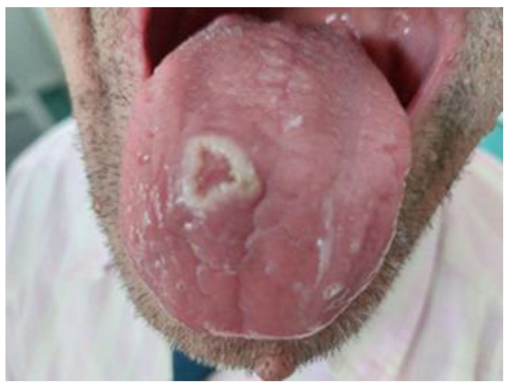 Life Free Full Text Ulceration And A White Lesion Of The Tongue In