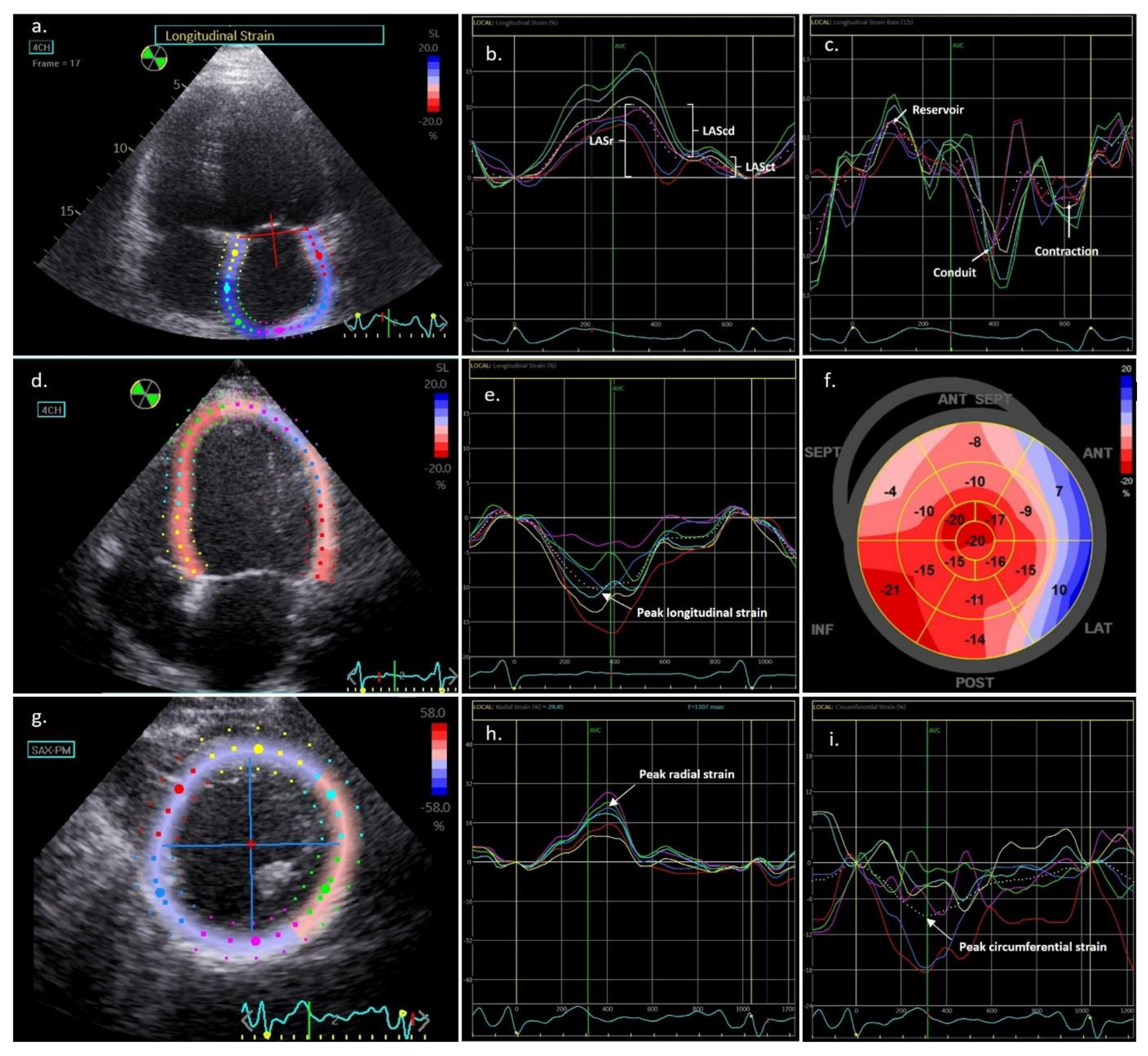 Two-dimensional speckle tracking echocardiography for the assessment of  atrial function