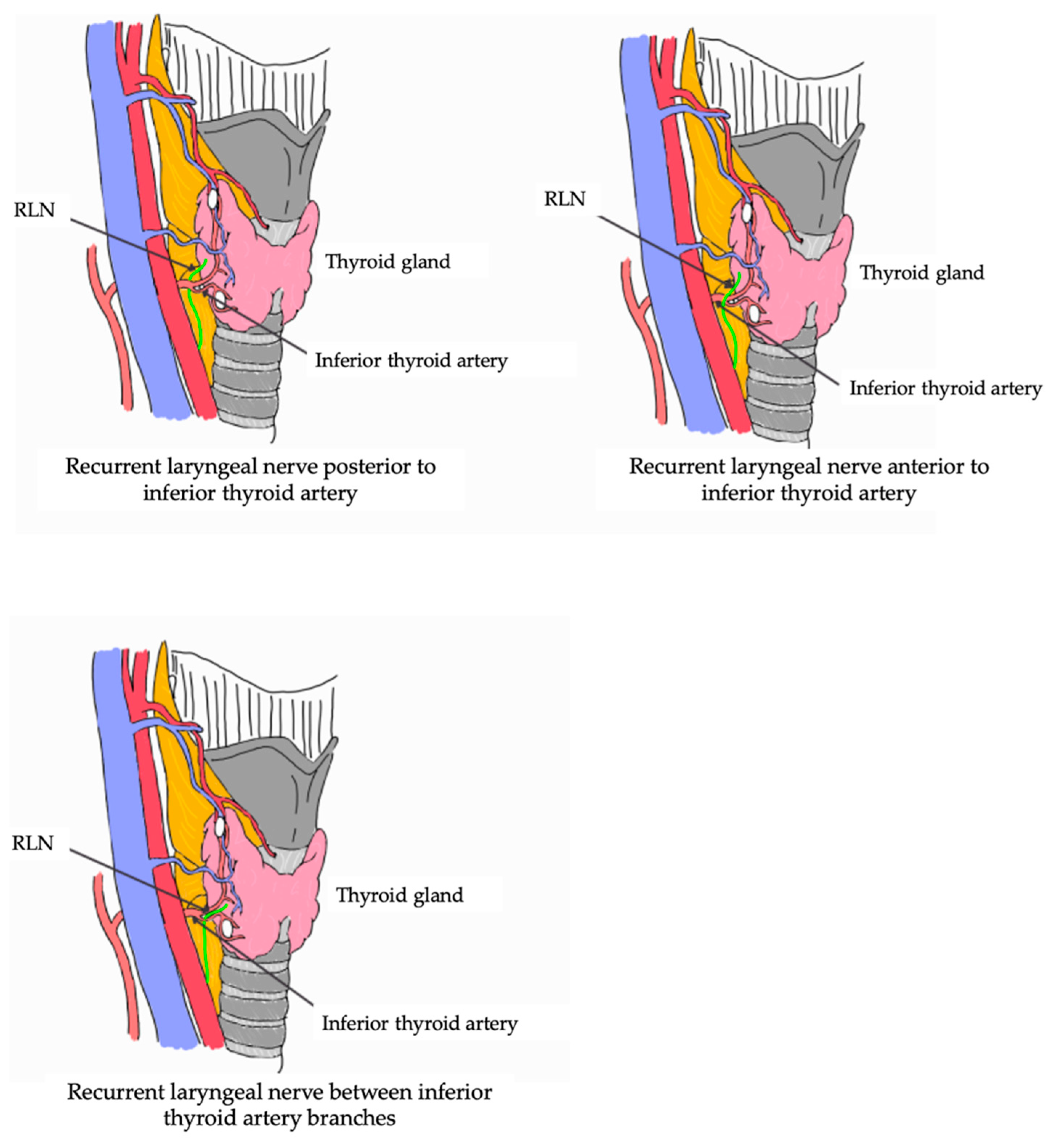 Recurrent Laryngeal Nerve