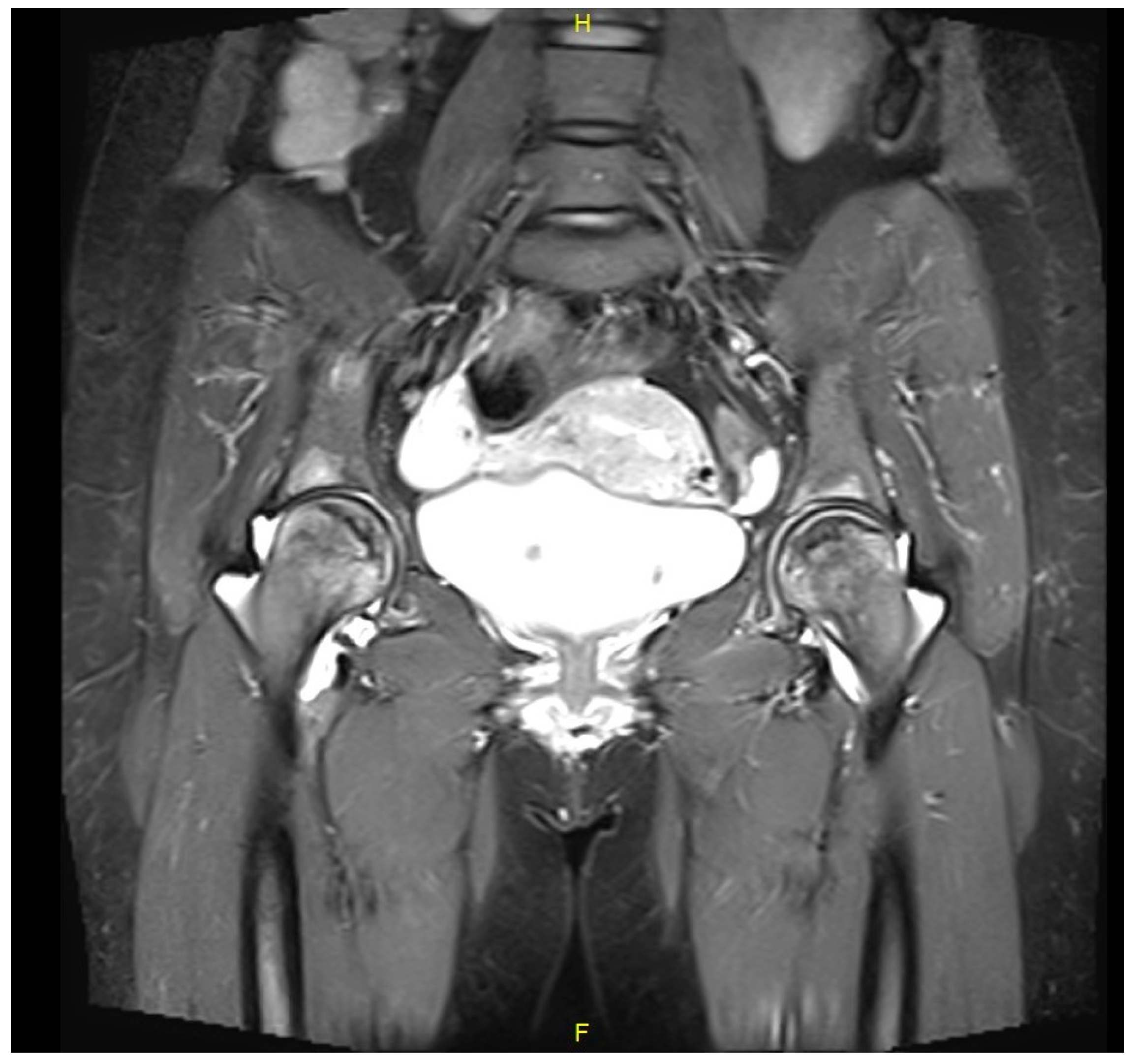 Simultaneous Bilateral Femoral Osteonecrosis in Gaucher Disease