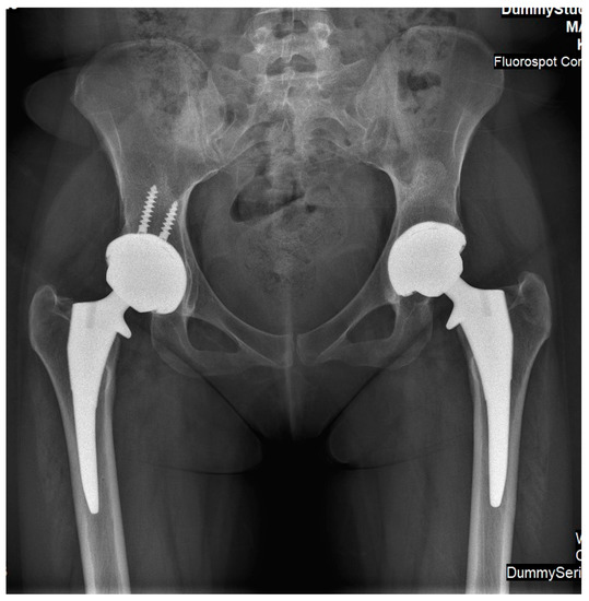 Simultaneous Bilateral Femoral Osteonecrosis in Gaucher Disease