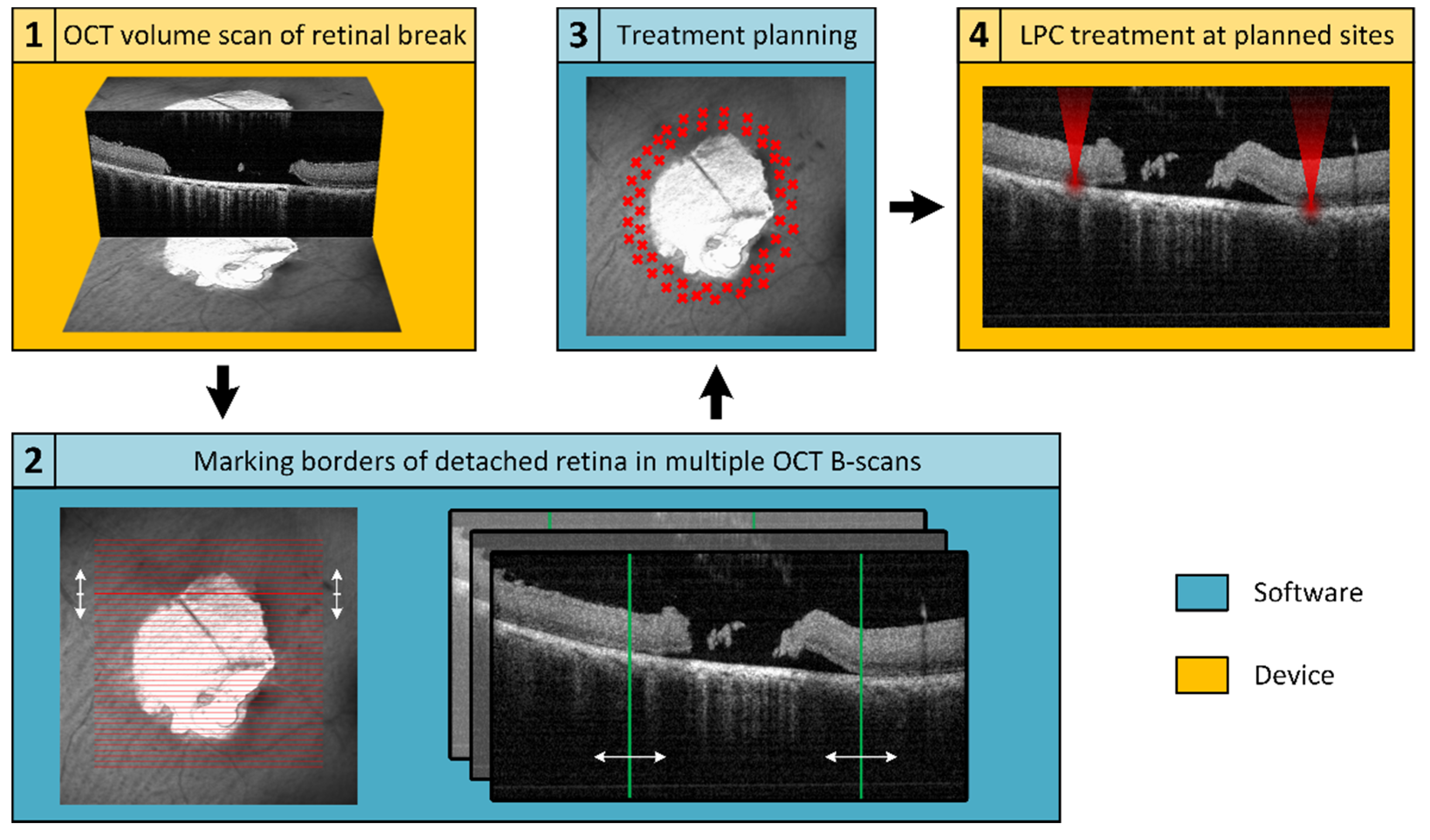 High-Precision Optical Coherence Tomography Navigated Laser