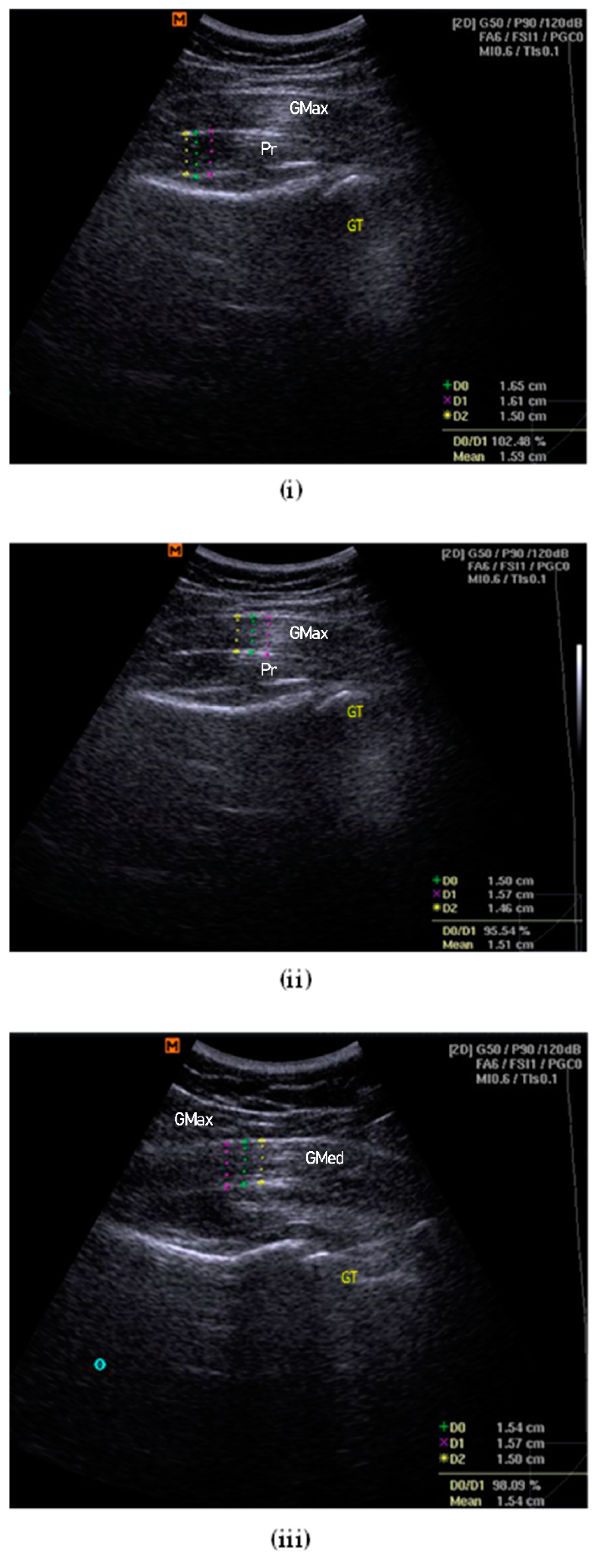56 Measurement of the Gluteal (hip)® girth showing a side and front view