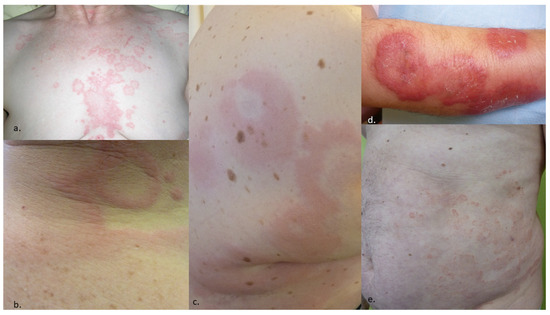 Widespread Tender Hemorrhagic Patches on the Breast