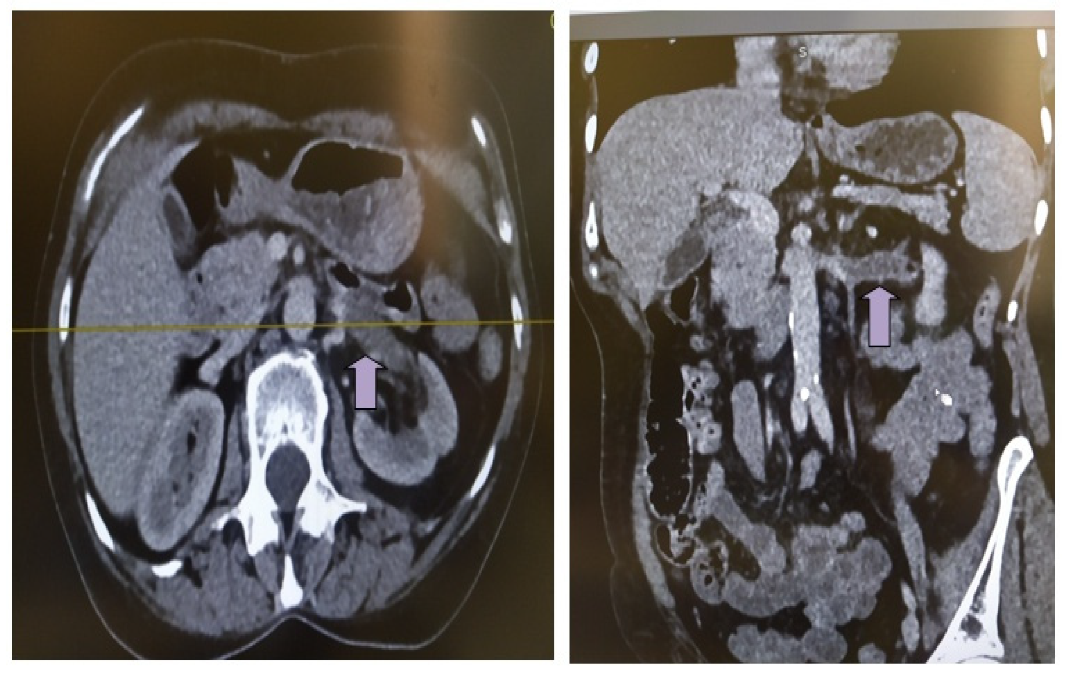 Life Free FullText Acute Renal Vein Thrombosis Following COVID19