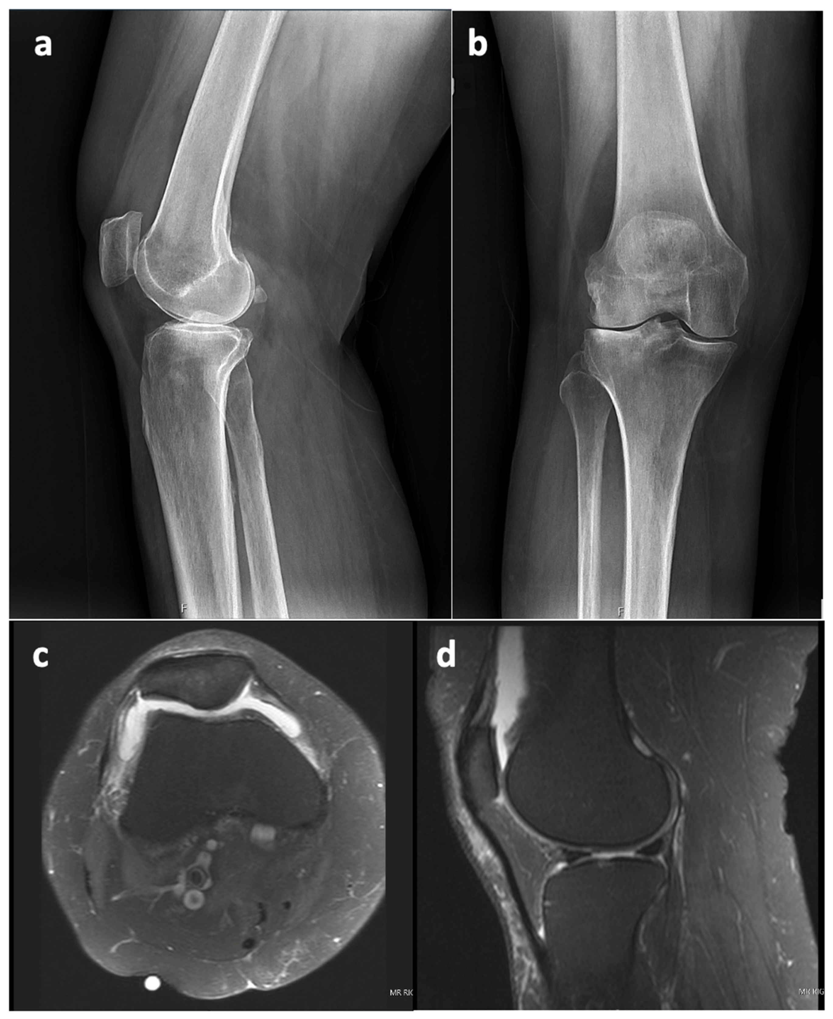De Novo Synovial Chondromatosis following Primary Total Knee