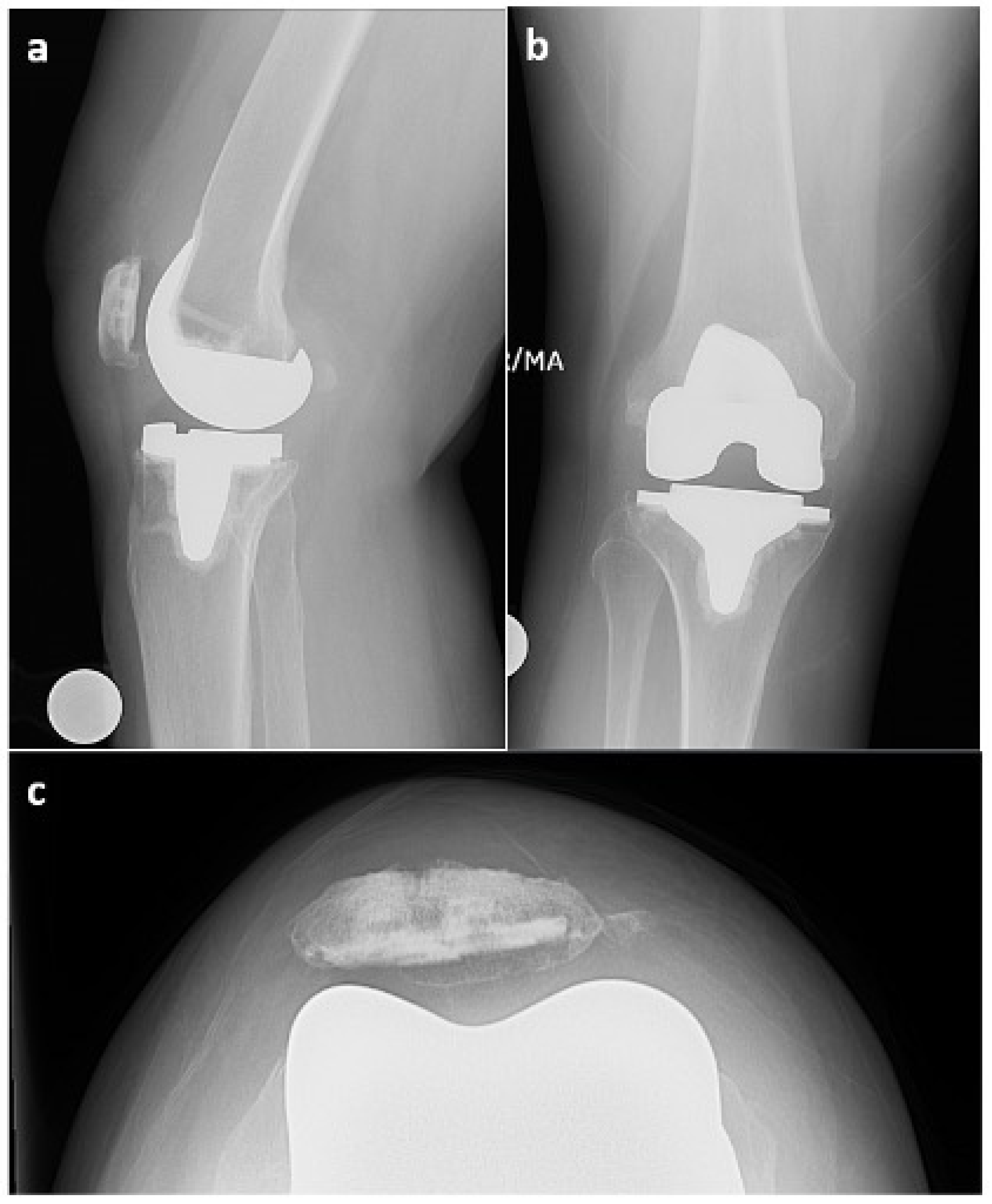 De Novo Synovial Chondromatosis following Primary Total Knee