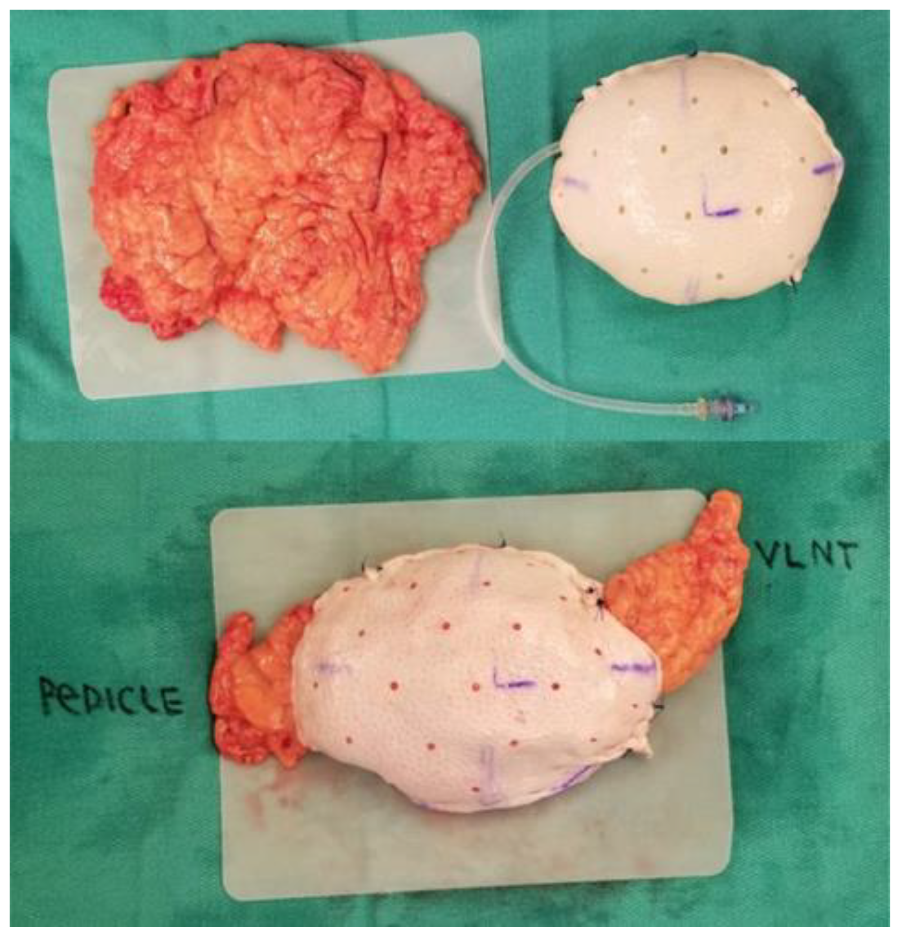 Life Free Full-Text Current Research on the Use of the Omental Flap in Breast Reconstruction and Post-Mastectomy Lymphedema A Focus on Omental-Vascularized Lymph Node Transfer pic
