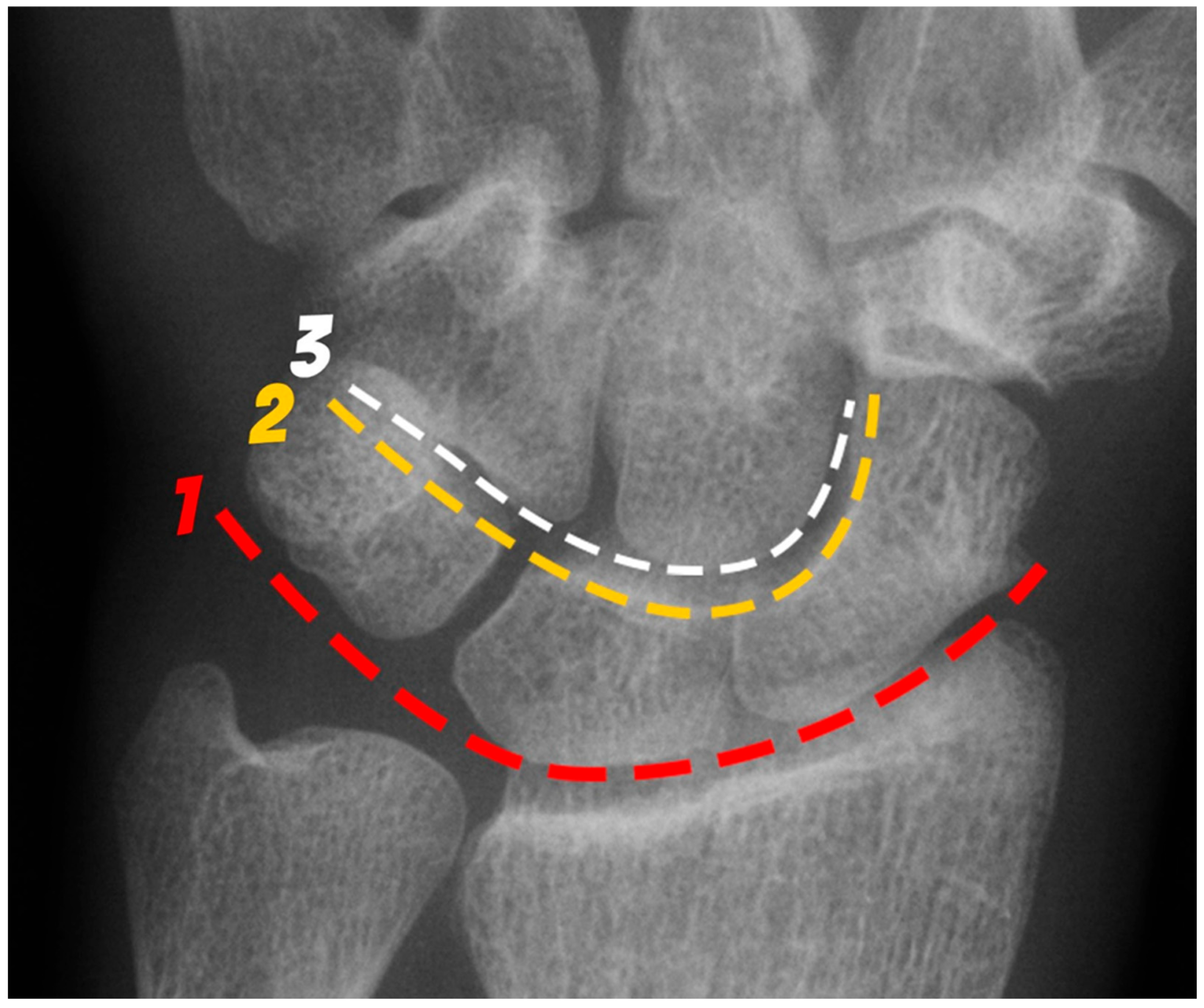 健康・医学 Distal Radius Fractures and Carpal Distal Radius Fractures and Carpal Instabilities: jetzt