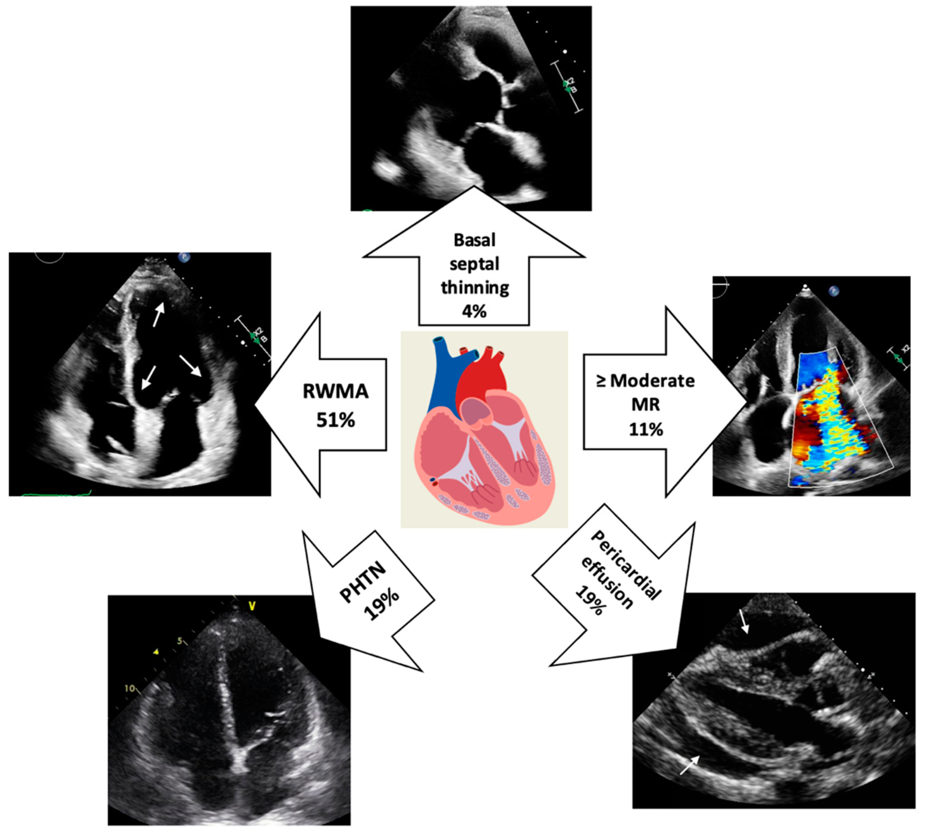 Left Ventricular Strain from Myocardial Perfusion PET Imaging: Method  Development and Comparison to 2-Dimensional Echocardiography