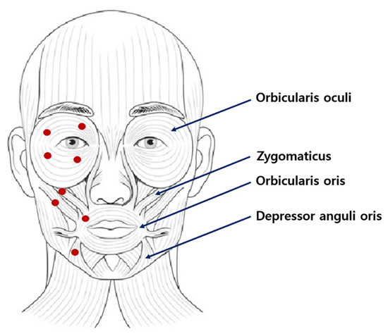 Life Free Full Text Clinical Application Of Botulinum Toxin For life-free-full-text-clinical-application-of-botulinum-toxin-for