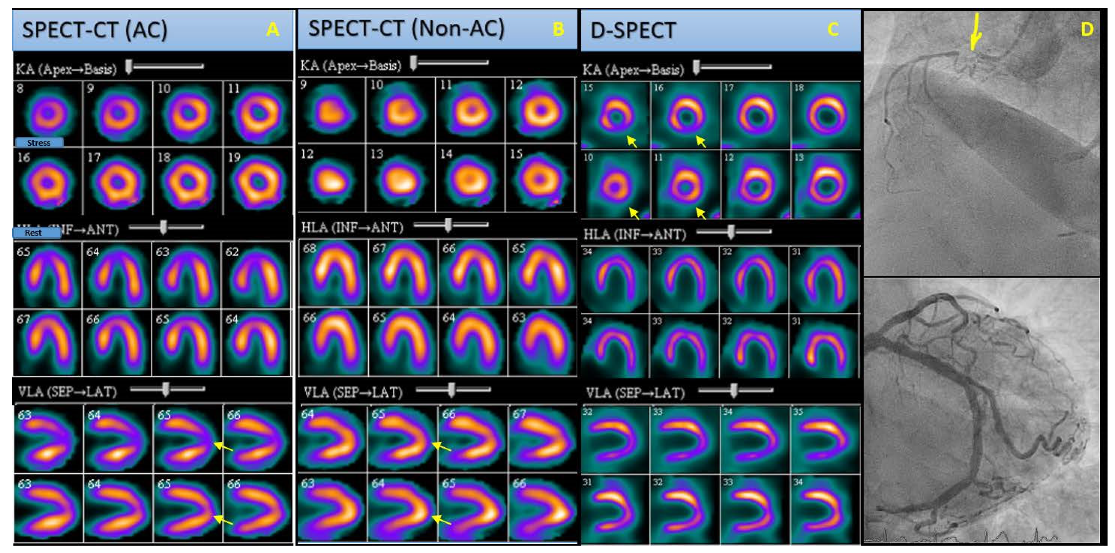 Life | Free Full-Text | Head-to-Head Comparison of CZT-SPECT and SPECT/CT  Myocardial Perfusion Imaging: Interobserver and Intraobserver Agreement and  Diagnostic Performance
