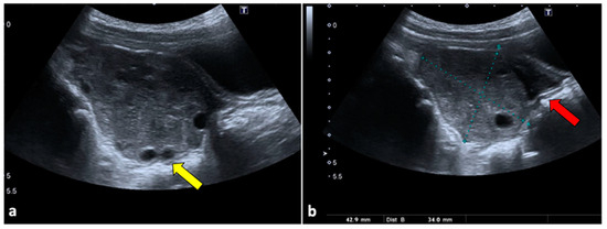 life-free-full-text-gynaecological-causes-of-acute-pelvic-pain