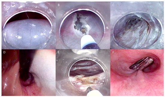 Precision Endoscopy in Peroral Myotomies for Motility Disorders of 