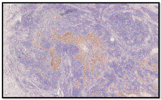 Pscc Epithelim Poorly Differentiated Cutaneous Squamous Cell Carcinoma (cSCC) or ...