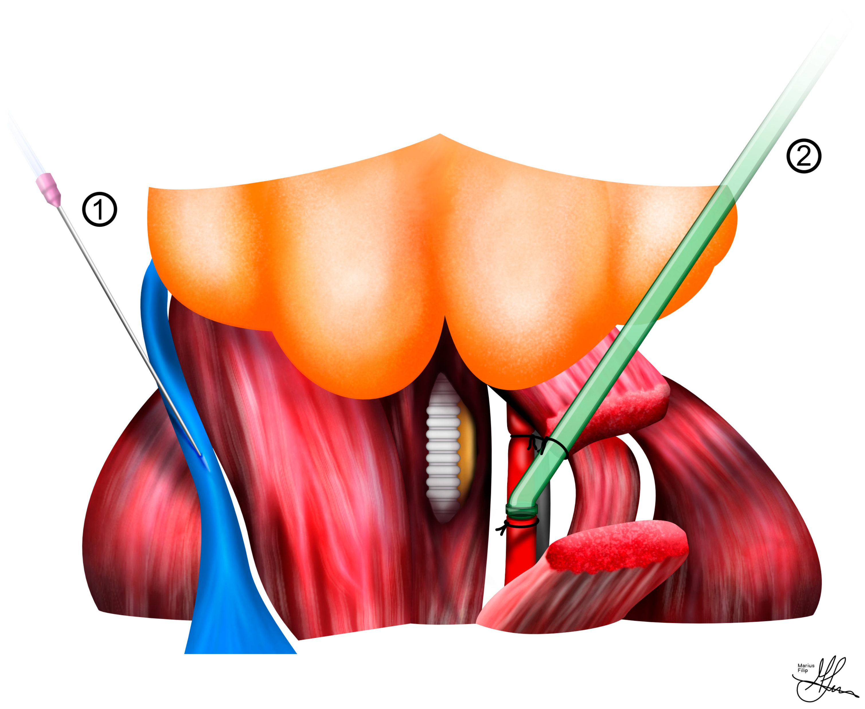 Topographic sketch. Coronal view of bilateral DRT (orange). Patient