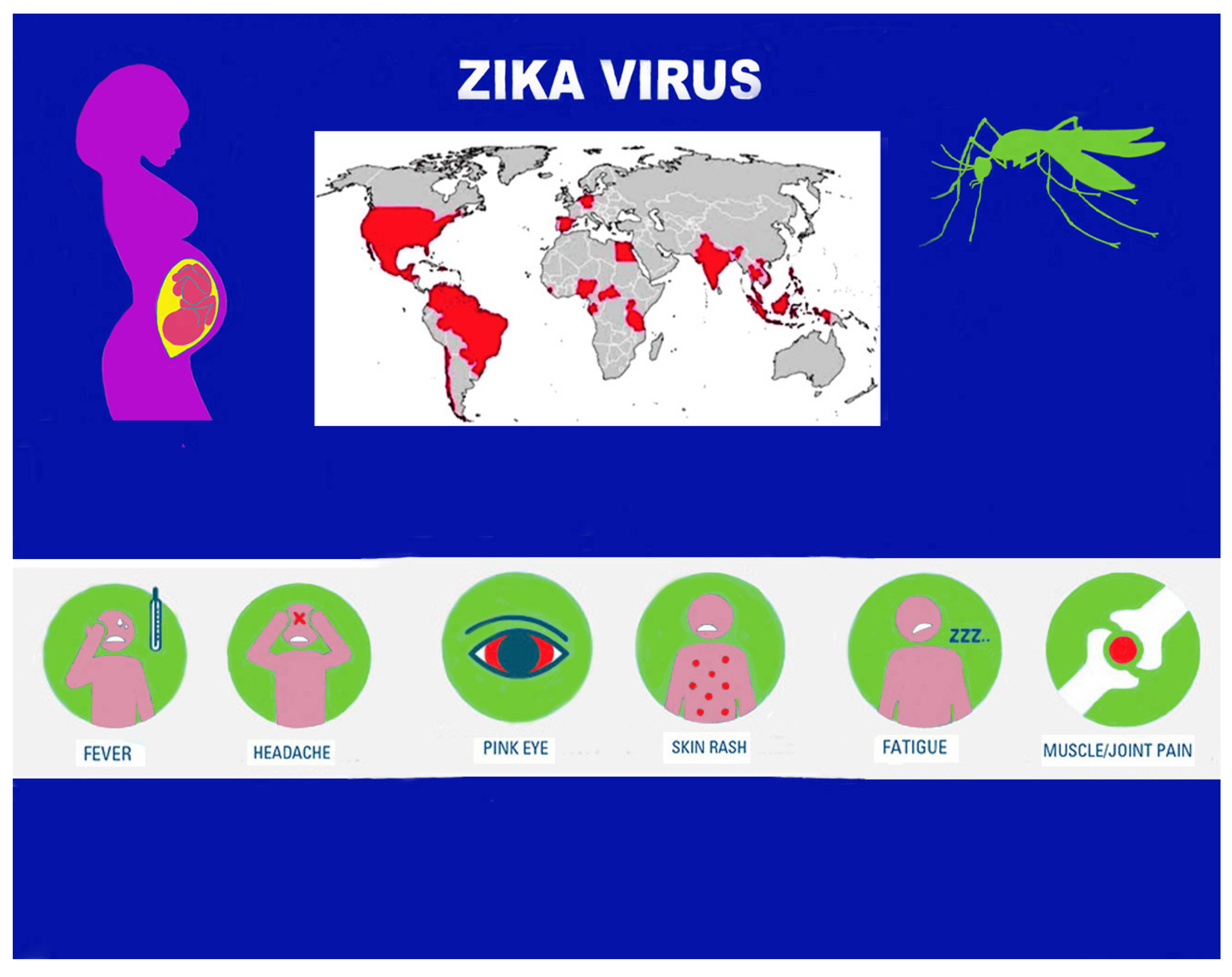 Life Free FullText Congenital Zika Virus Syndrome Microcephaly