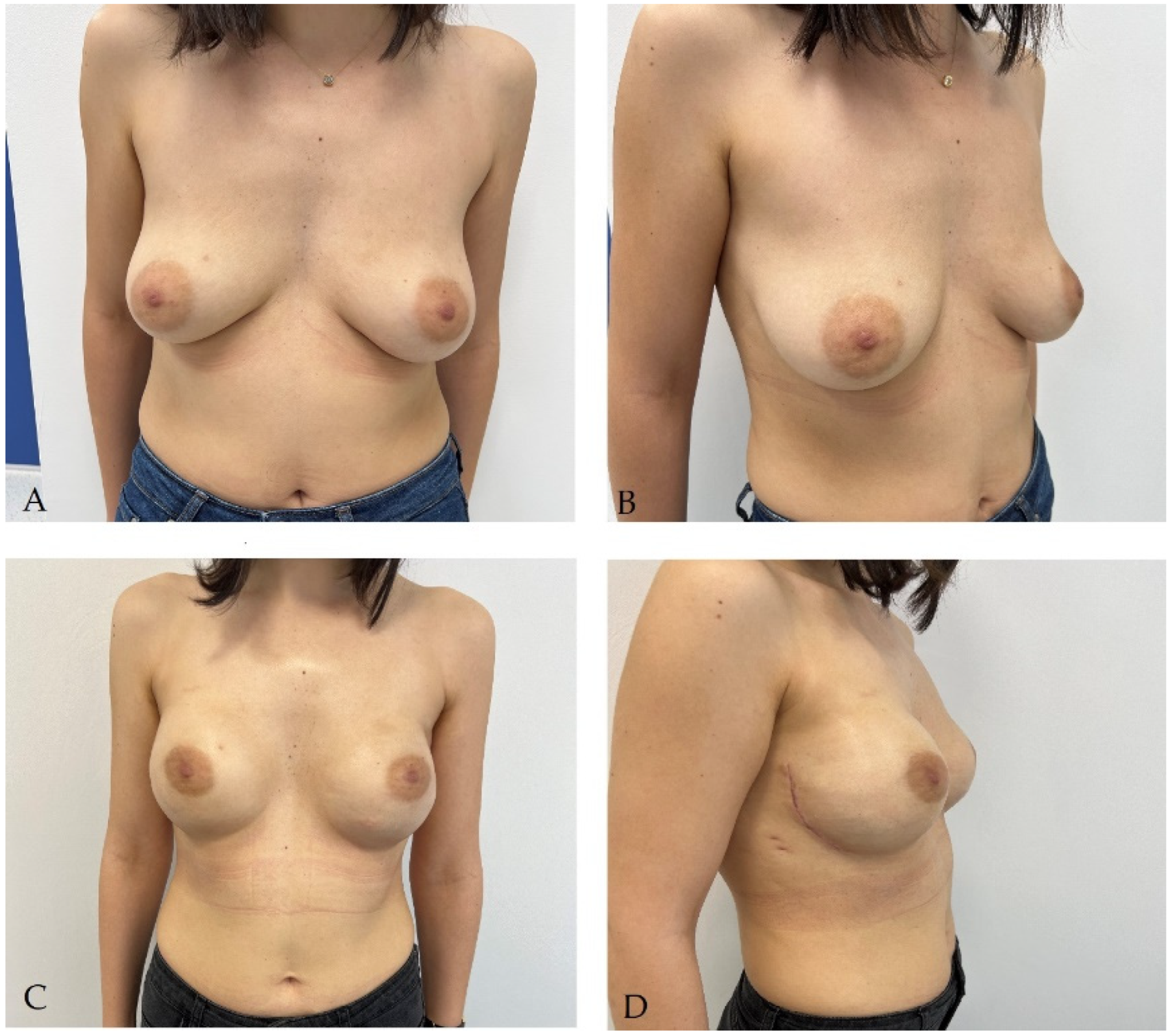 Junior jc small tits Breast Reconstruction following Mastectomy for Breast Cancer or  Prophylactic Mastectomy: Therapeutic Options and Results