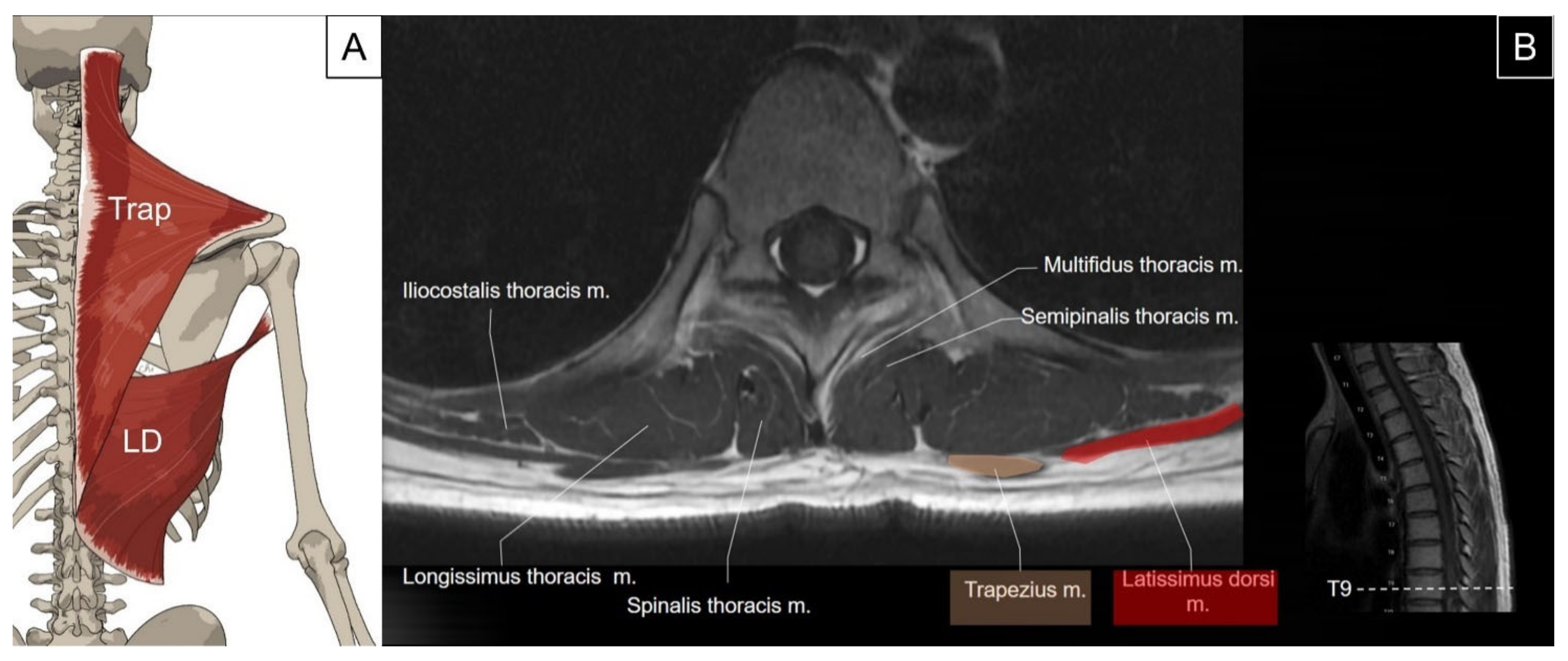Pictorial Essay on Ultrasound and Magnetic Resonance Imaging of 