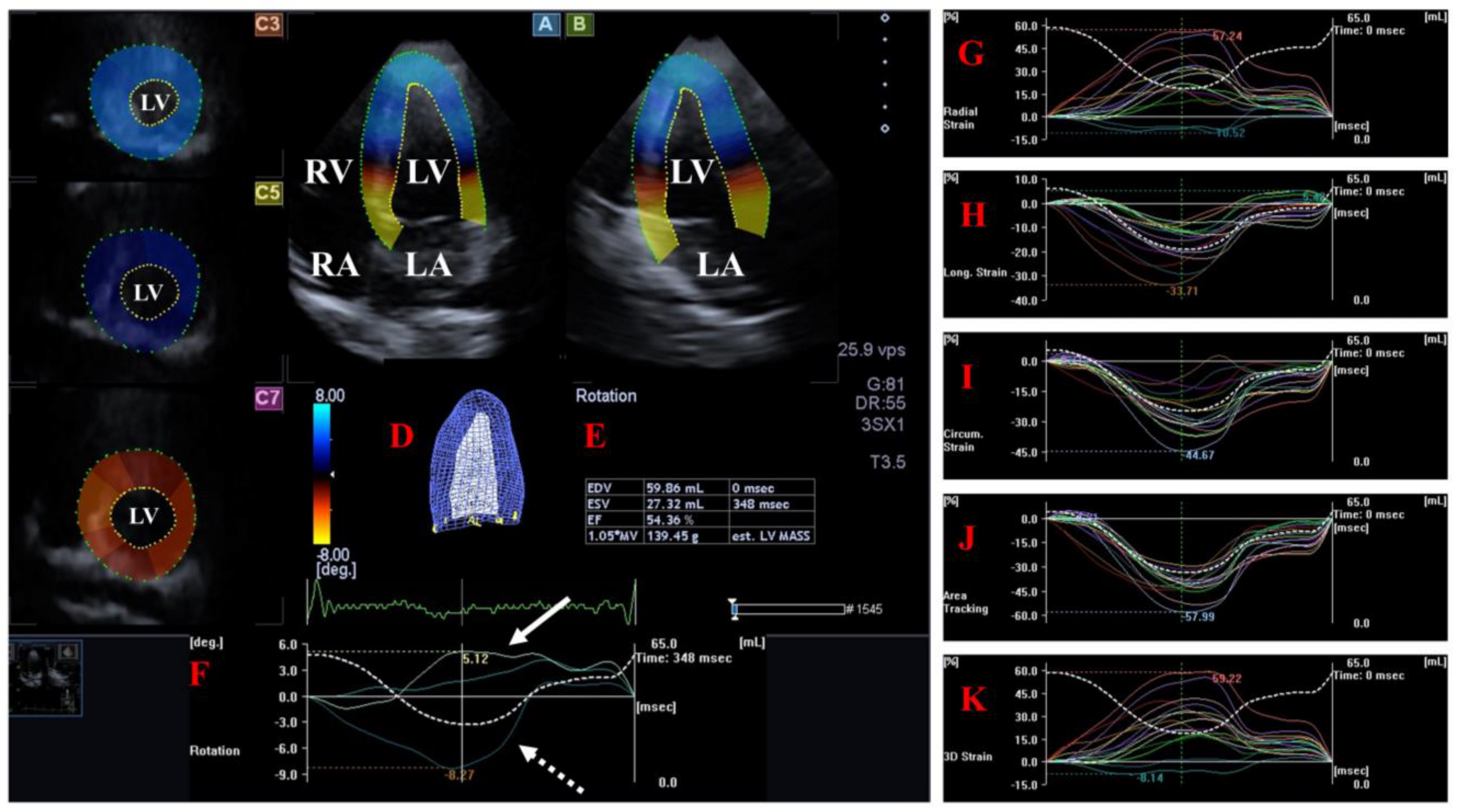 Myocardial, Valvular and Vascular Abnormalities in Repaired Tetralogy of Fallot Myocardial, Valvular and Vascular Abnormalities in Repaired Tetralogy of Fallot